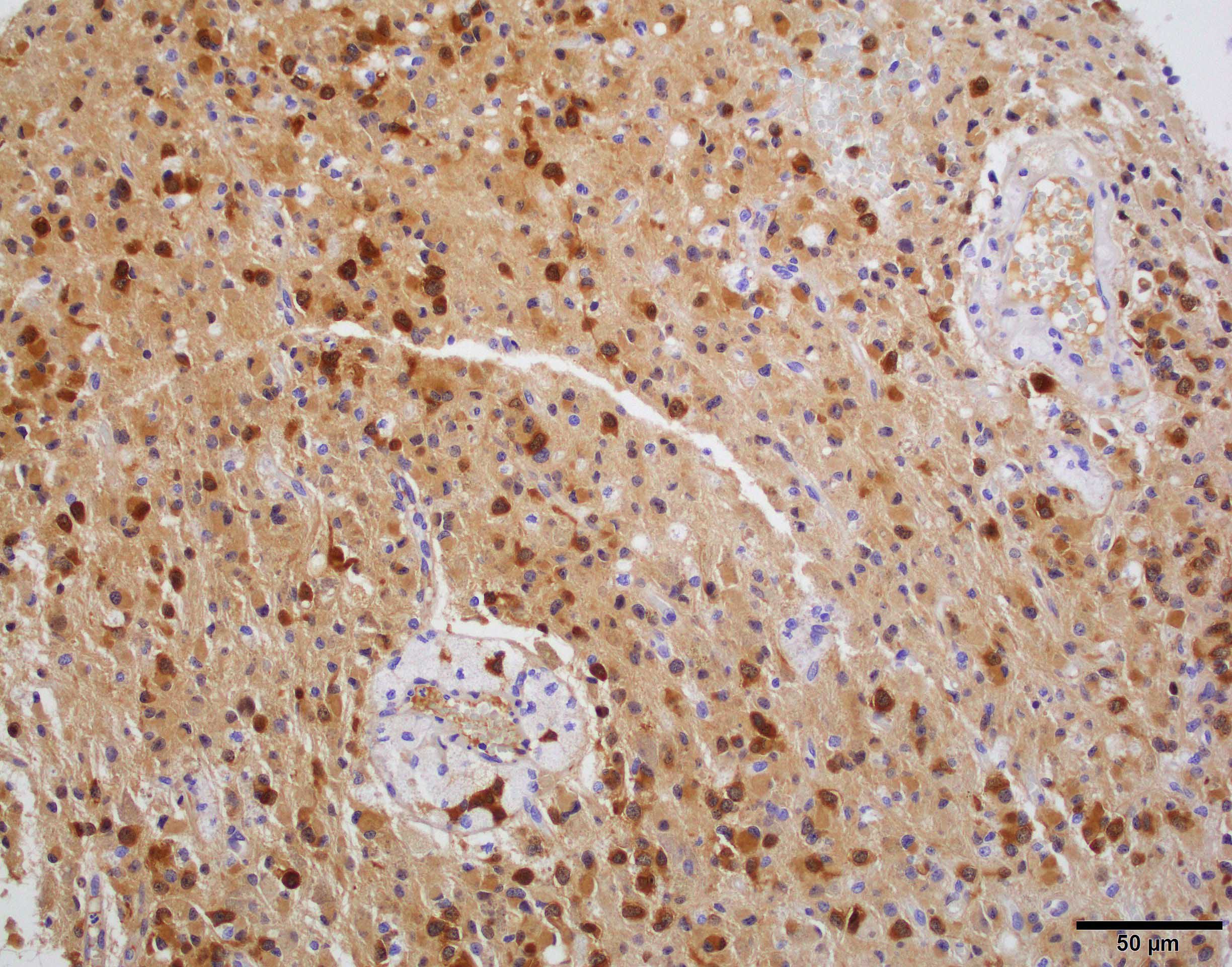IDH low grade astrocytoma