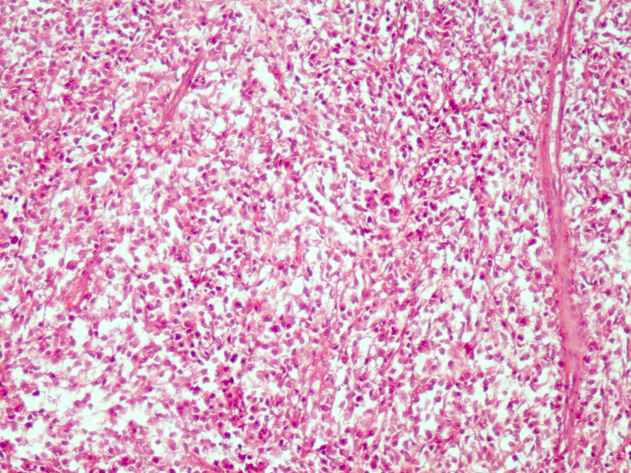 Diffuse large B cell lymphoma