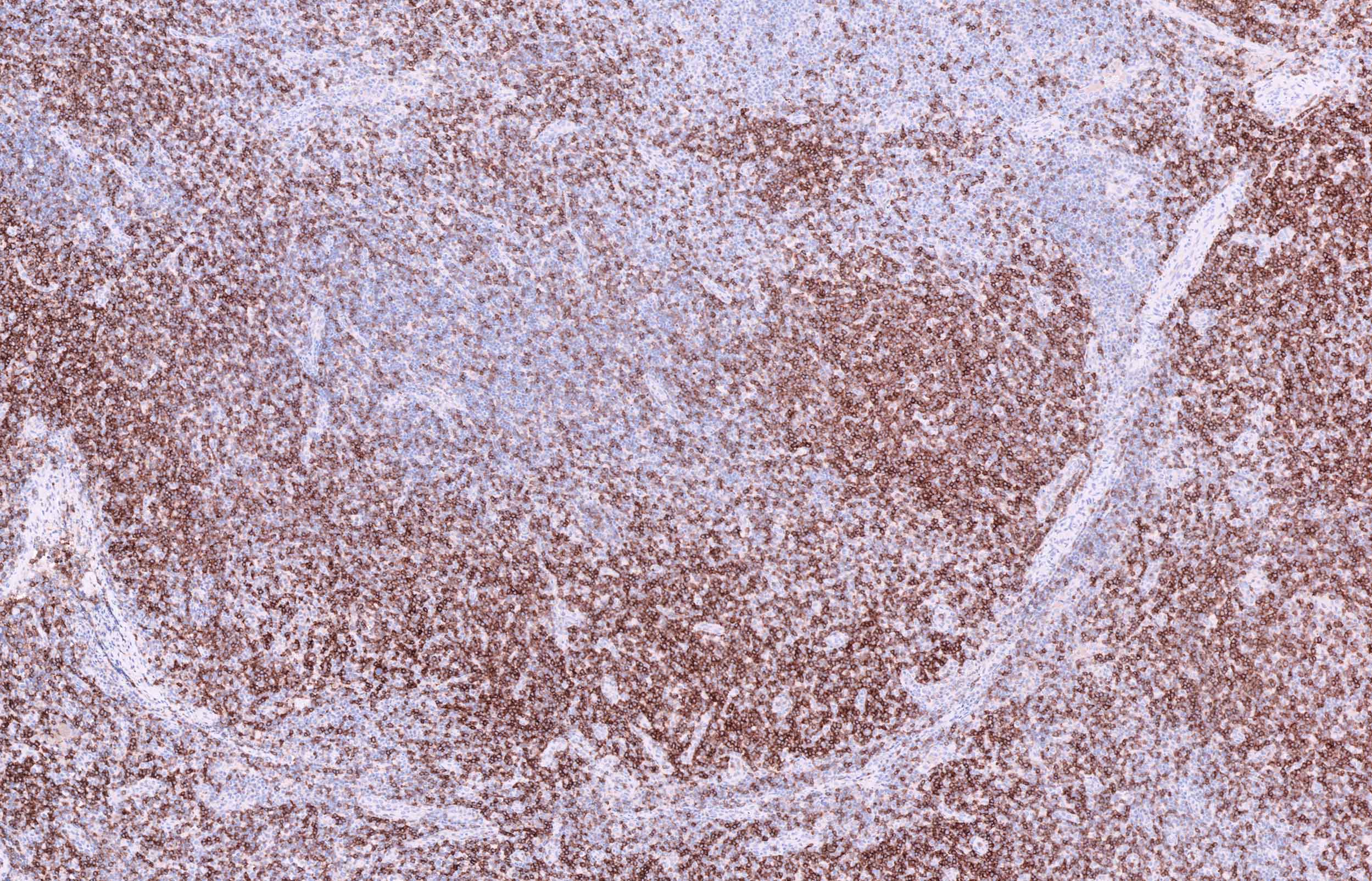 Angioimmunoblastic T cell lymphoma