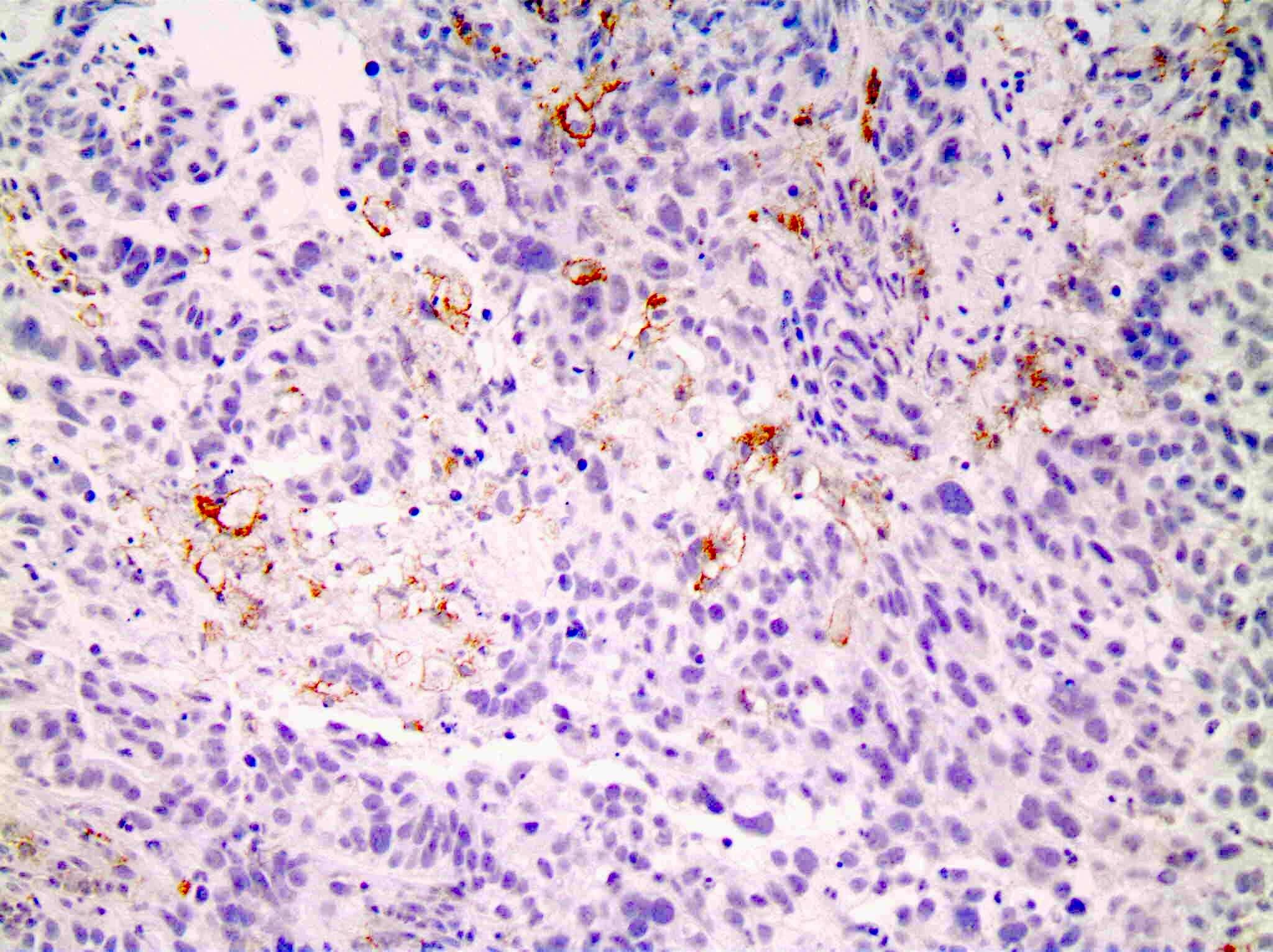 Esophagus, invasive adenocarcinoma