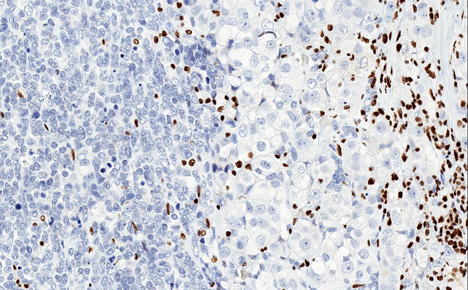 Ovarian small cell carcinoma, hypercalcemic type
