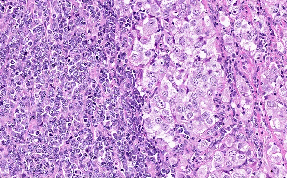 Ovarian small cell carcinoma, hypercalcemic type