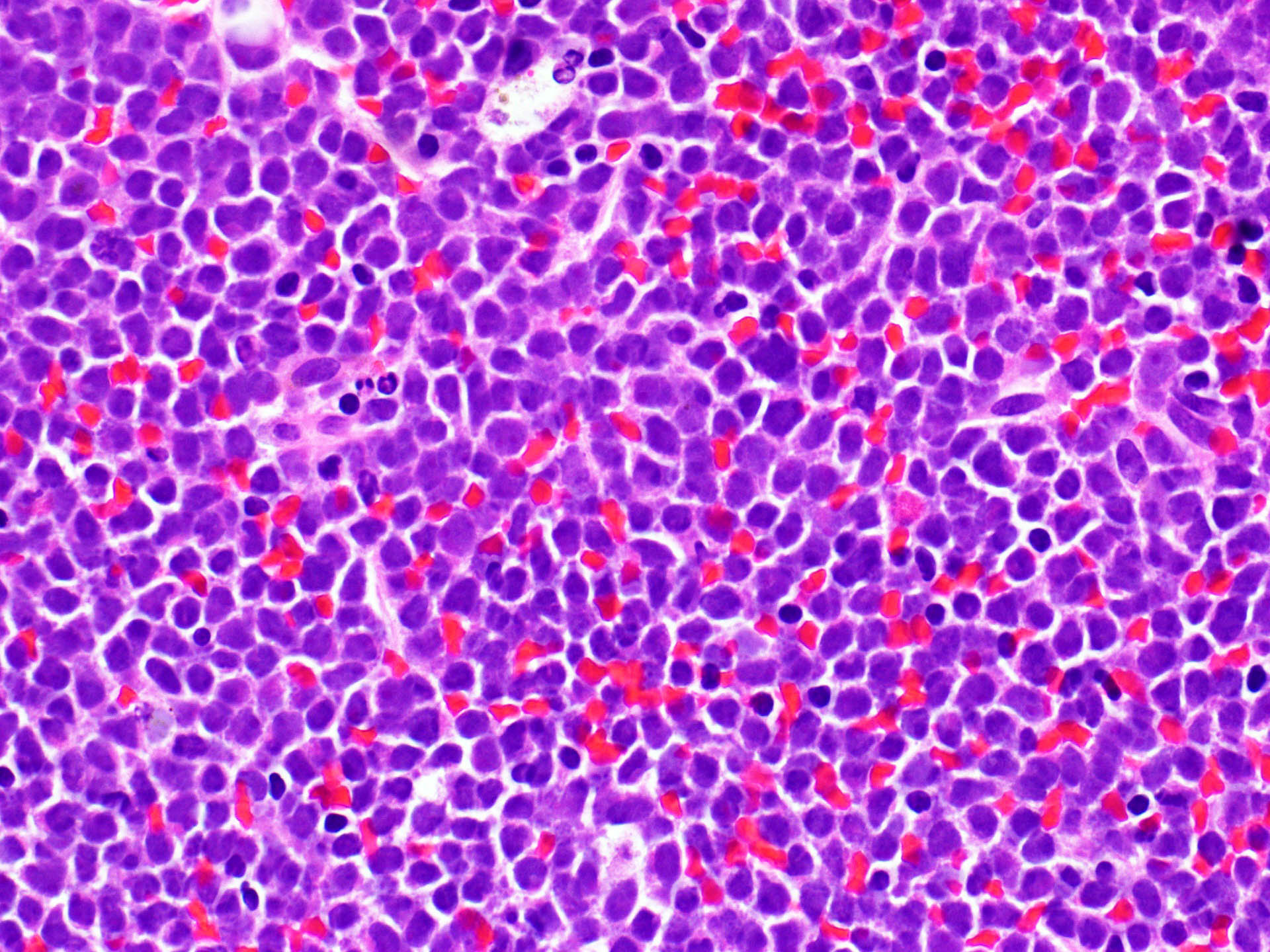 B lymphoblastic leukemia / lymphoma