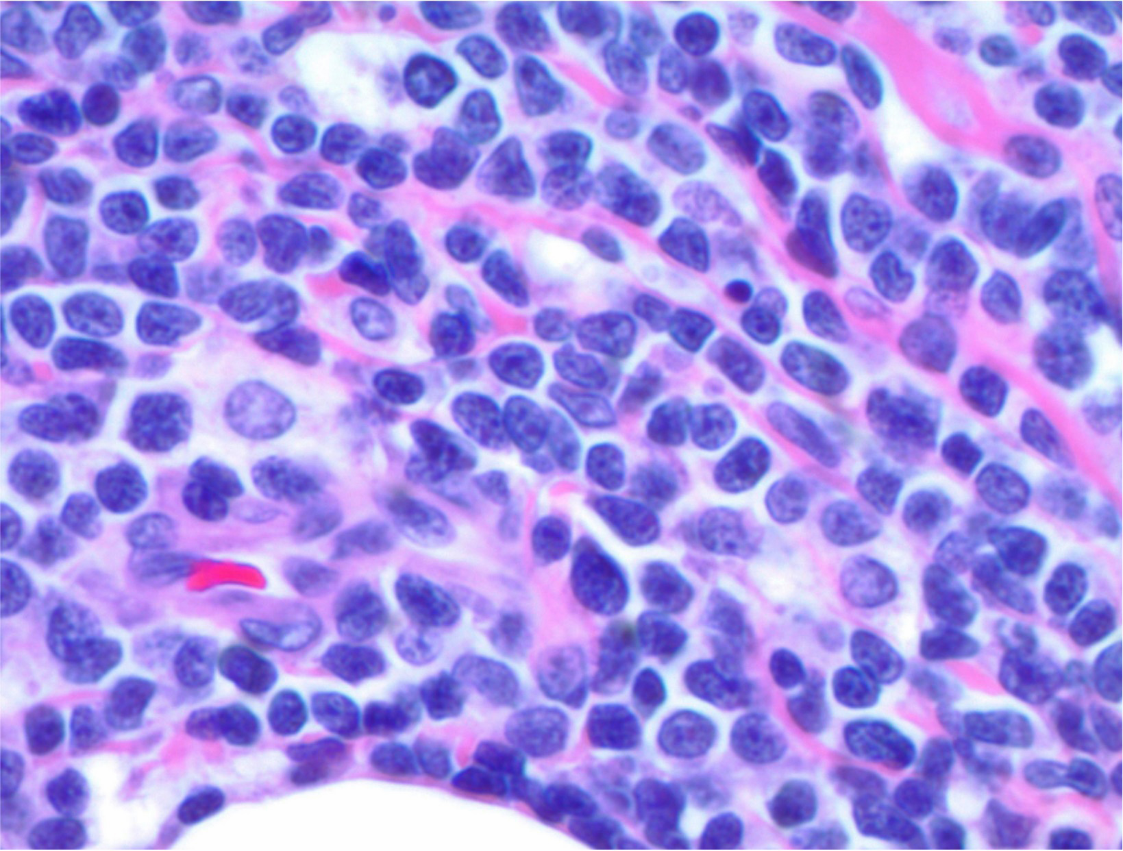 T lymphoblastic lymphoma