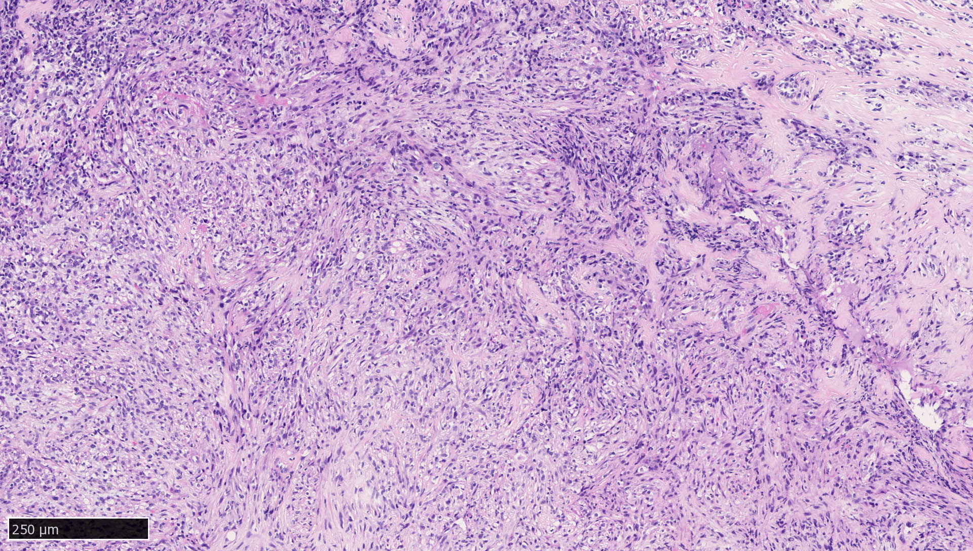 Mammary spindle cell carcinoma