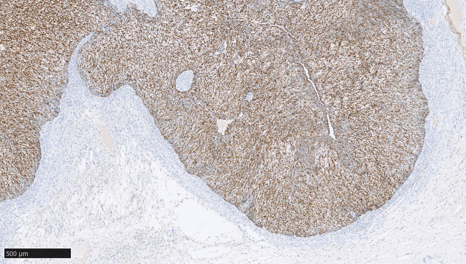 Juvenile granulosa cell tumor
