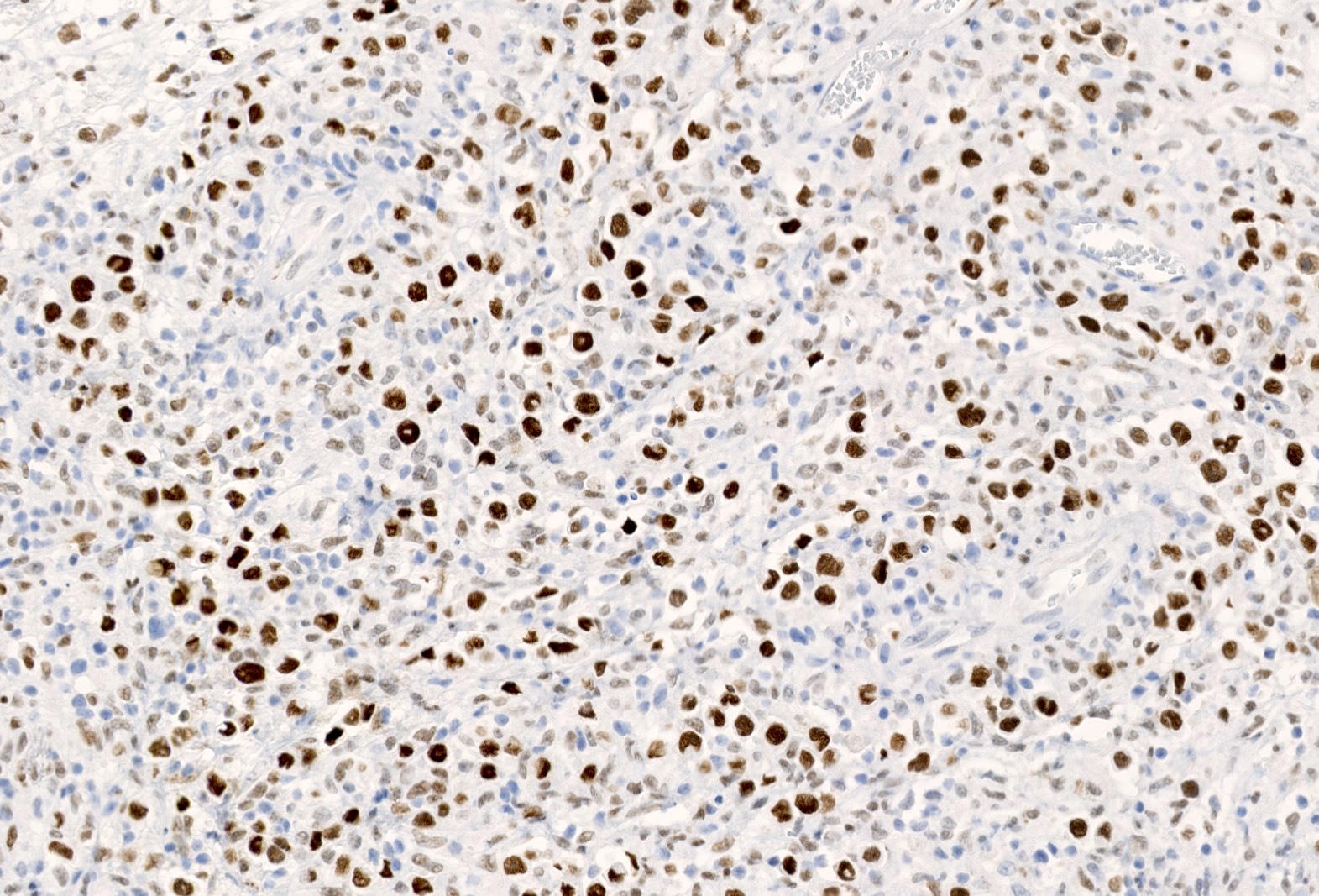 T cell / histiocyte rich large B cell lymphoma (H&E and BCL6)