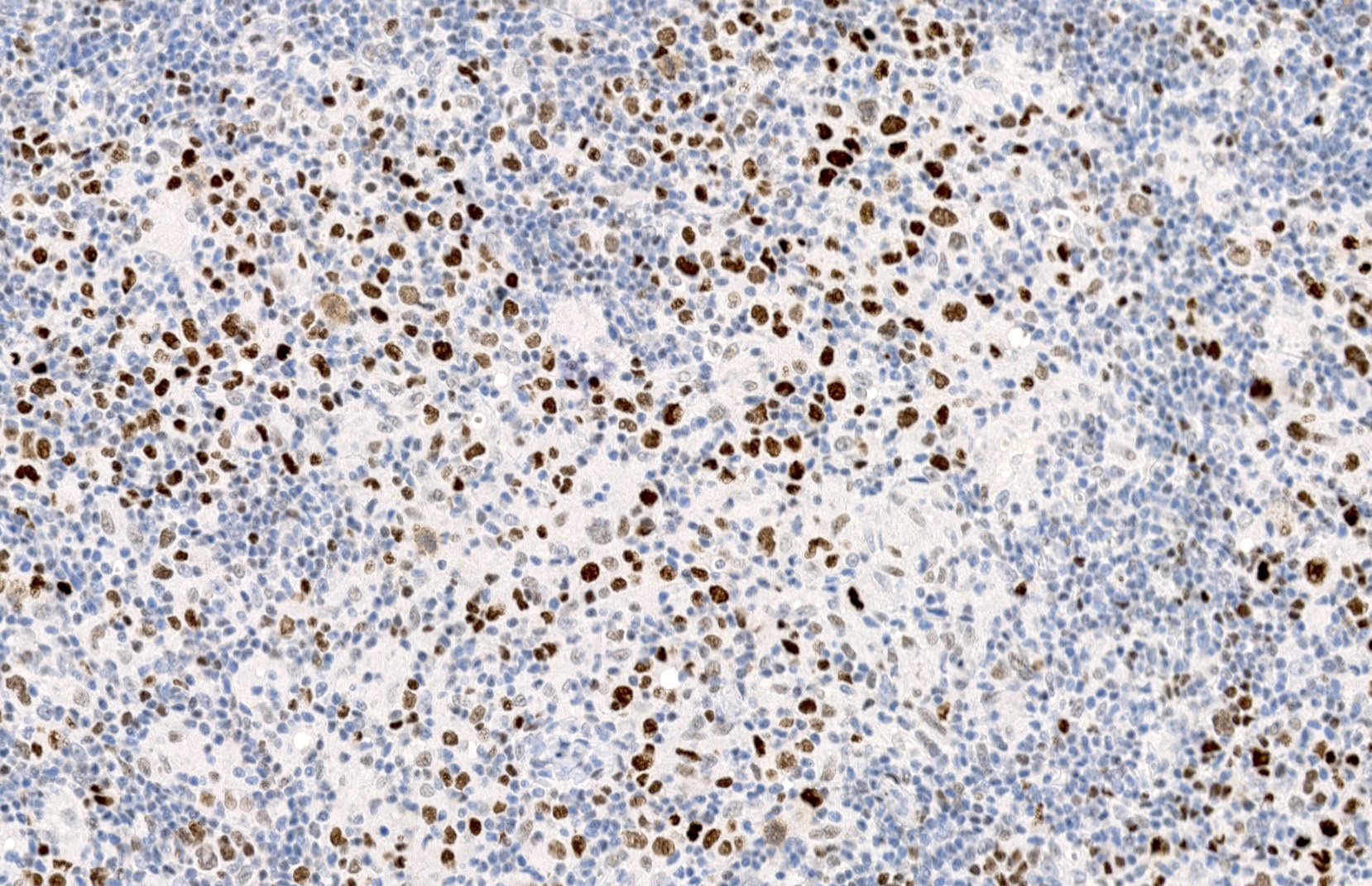 Nodular lymphocyte predominant Hodgkin lymphoma (H&E and BCL6)