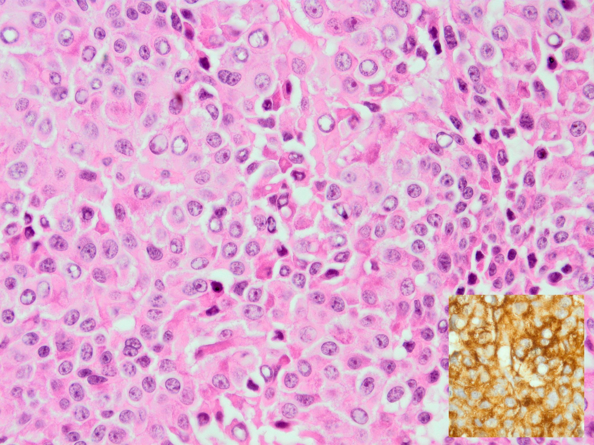 CAM 5.2 in Crooke cell adenoma