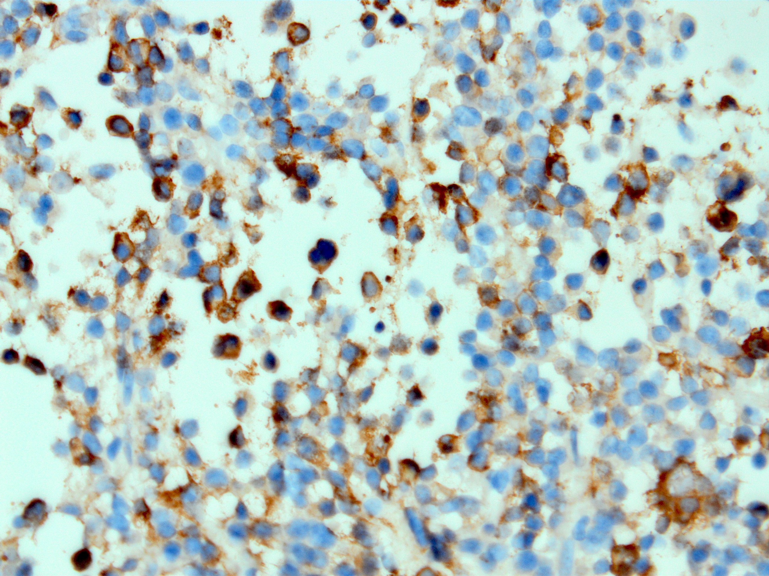 CAM 5.2 in sparsely granulated somatotroph adenoma