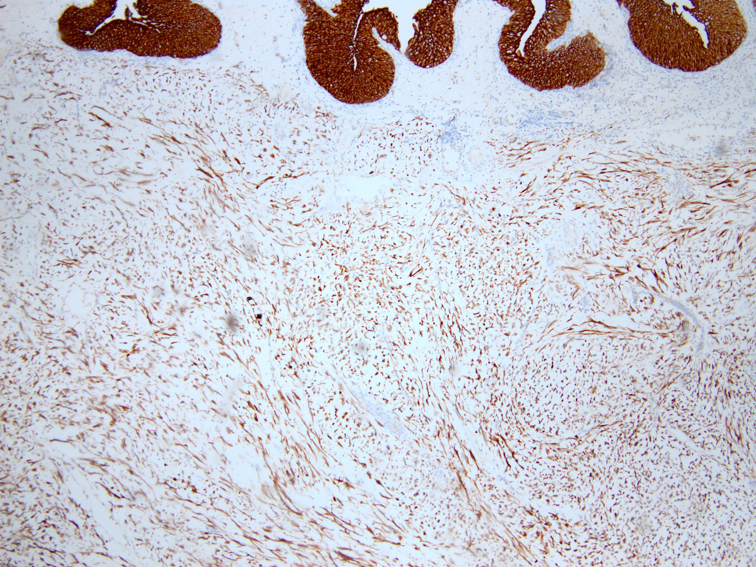 Inflammatory myofibroblastic tumor of the bladder