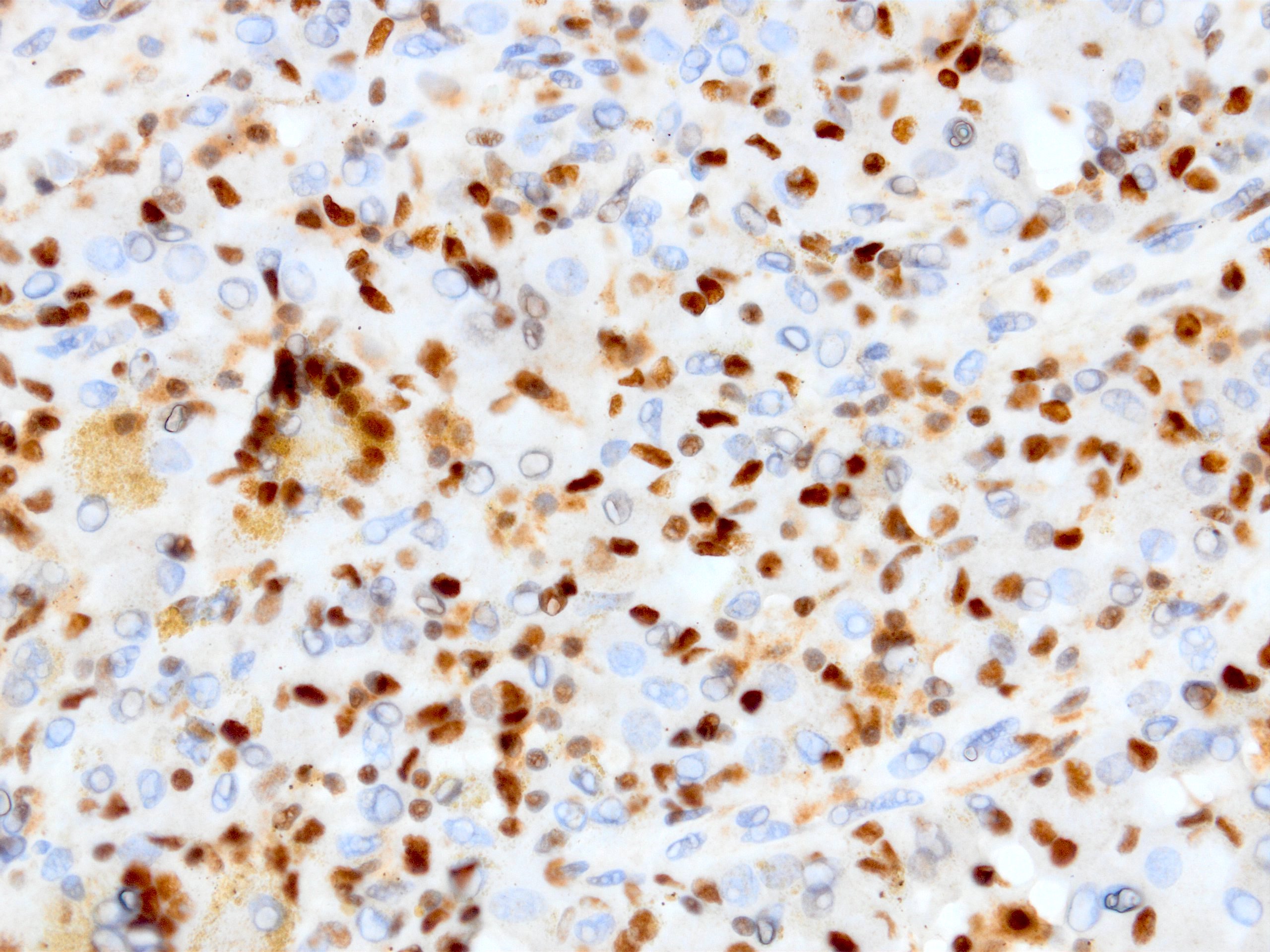 CAM 5.2 in epithelioid sarcoma (proximal variant)
