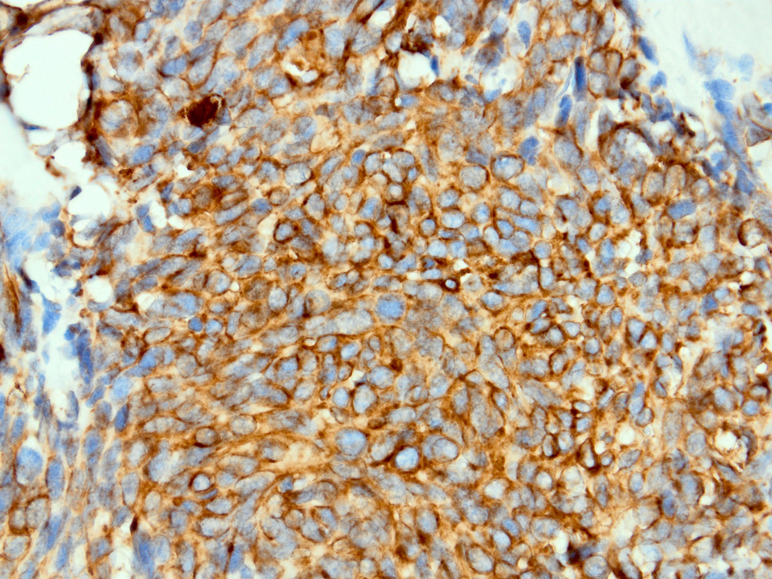 CAM 5.2 in desmoplastic small round cell tumor