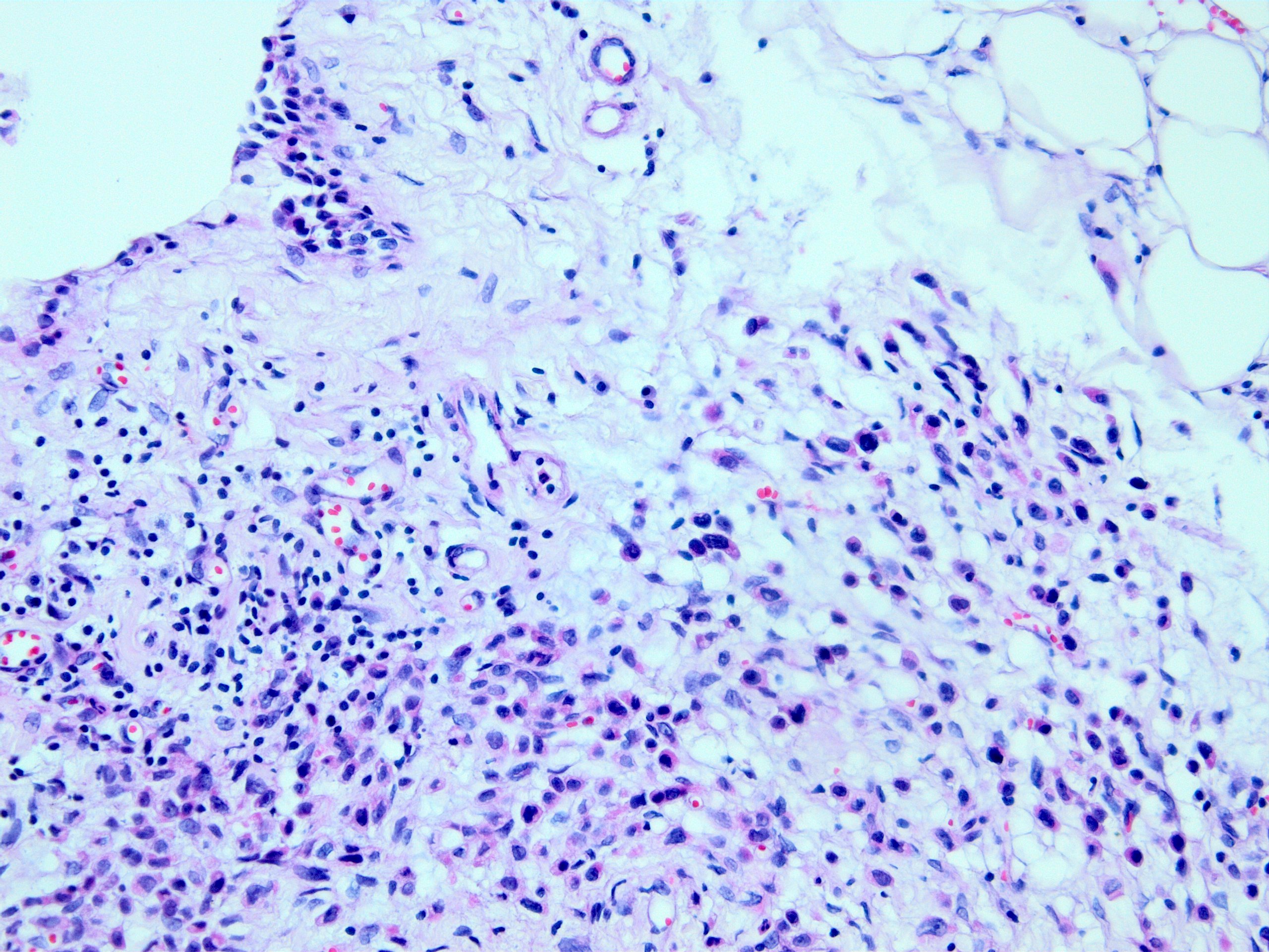 Signet ring carcinoma infiltrating omentum