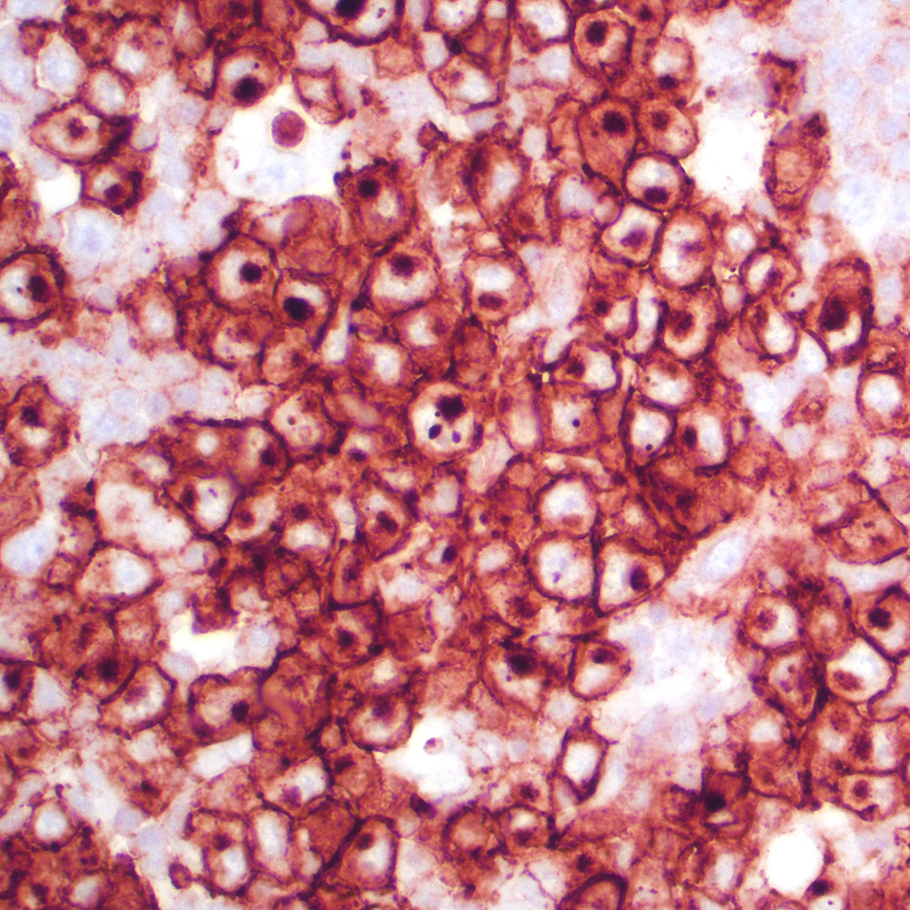 ALK+ anaplastic large cell lymphoma in lymph node