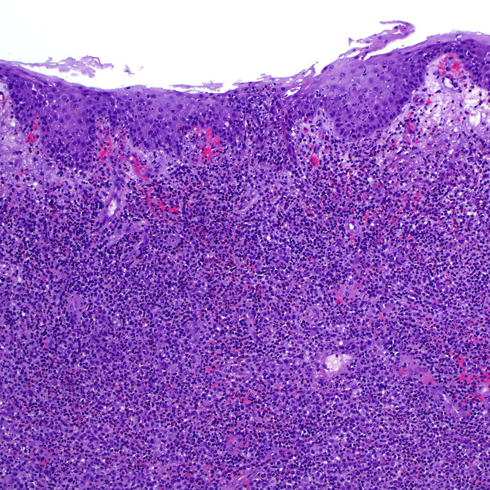 Lymphomatoid papulosis type C