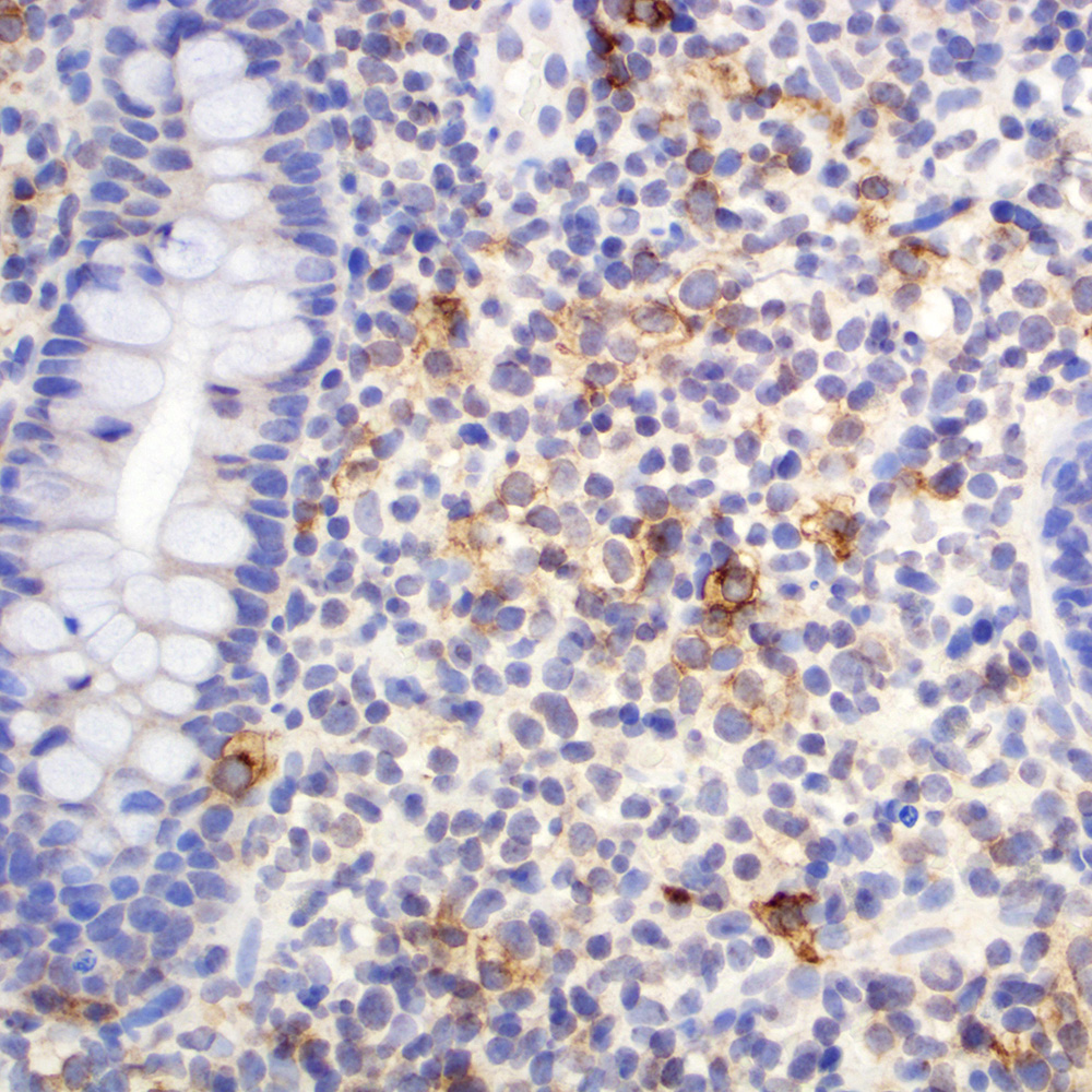 Peripheral T cell lymphoma, NOS, in colon