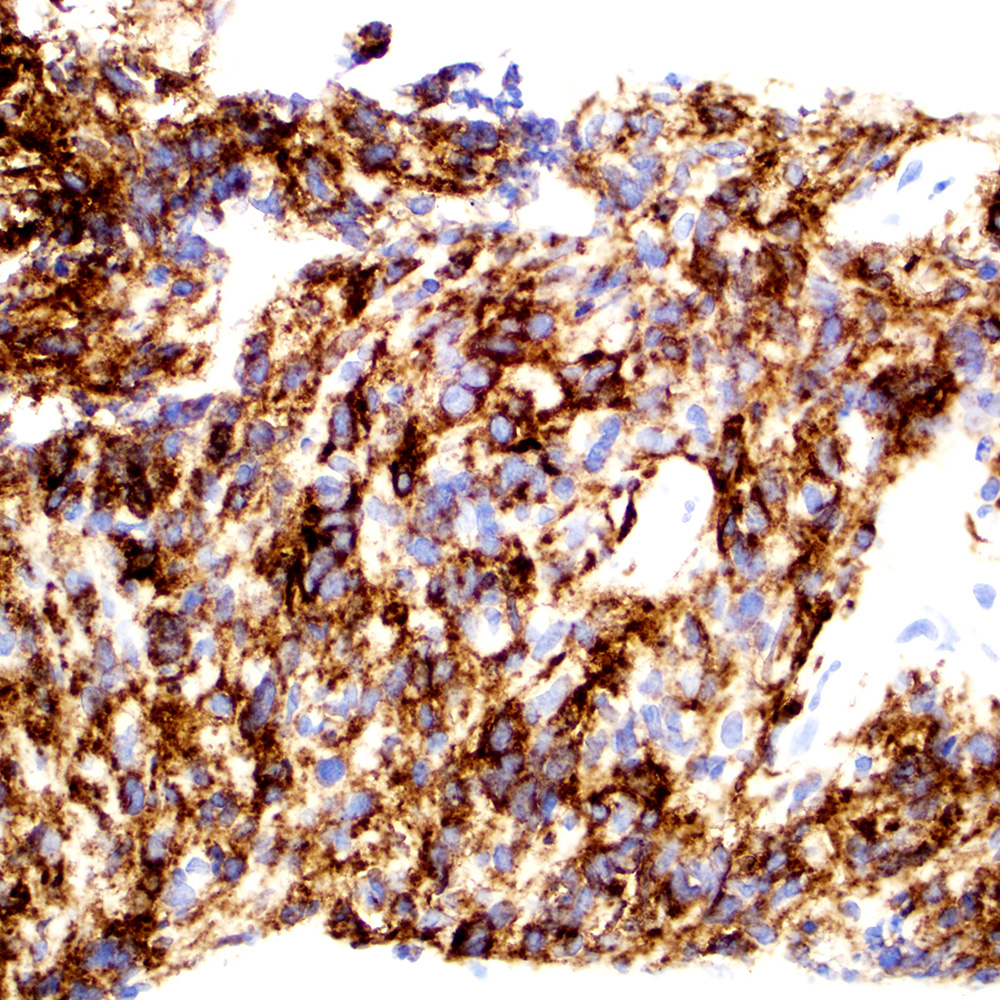 Primary mediastinal large B cell lymphoma