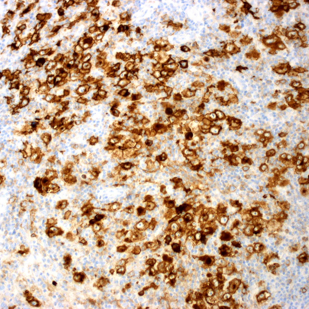 Nodular sclerosis classic Hodgkin lymphoma, syncytial variant