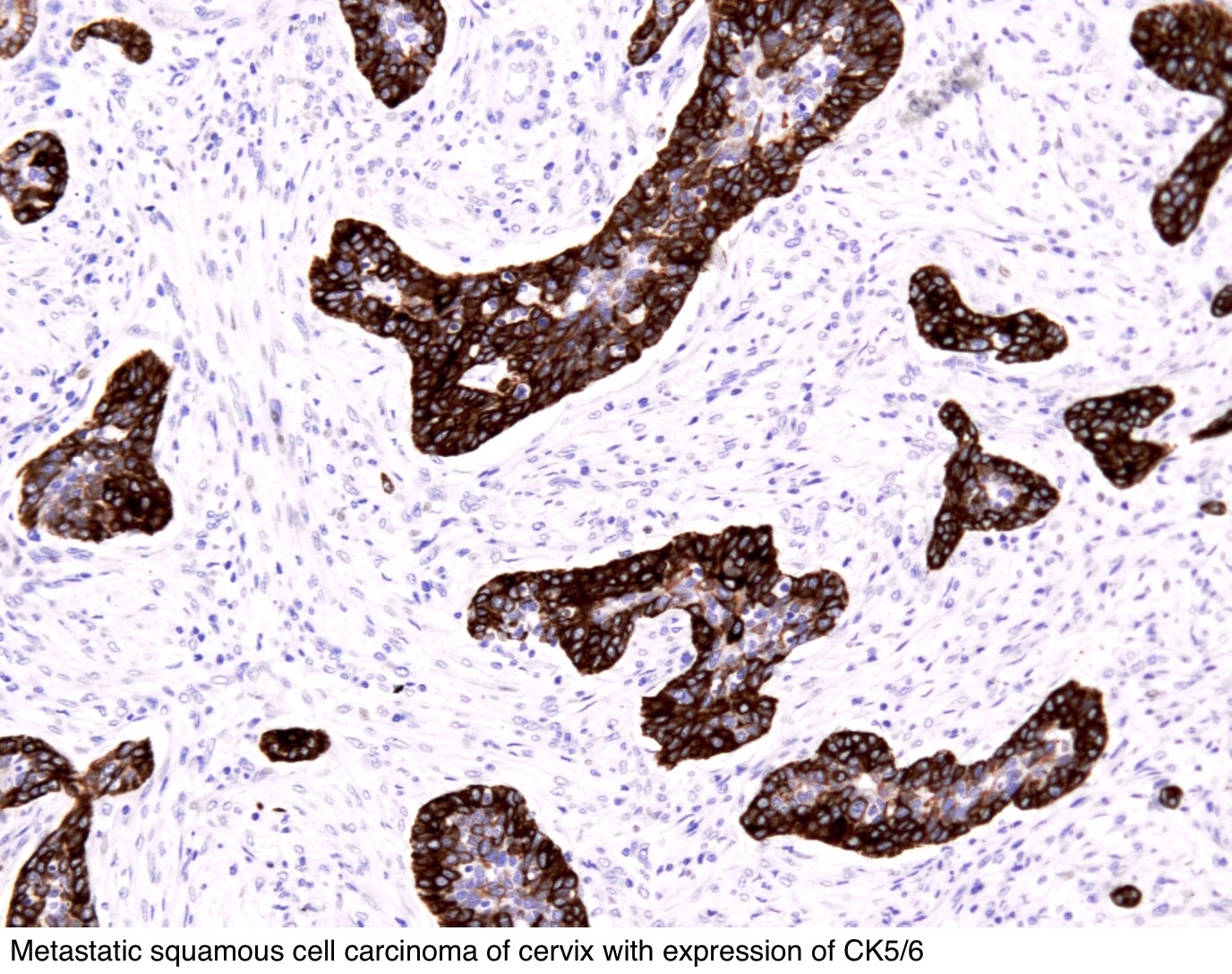 a potential test for malignant pleural mesothelioma