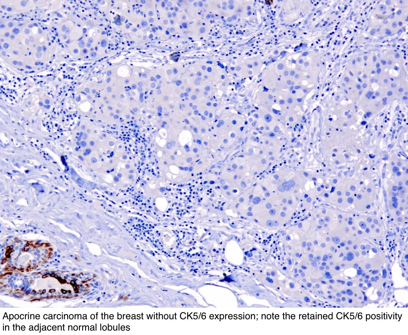 A mell papilláris elváltozásainak diagnosztikai értékelése a mag biopszián Ck5 6 papilloma