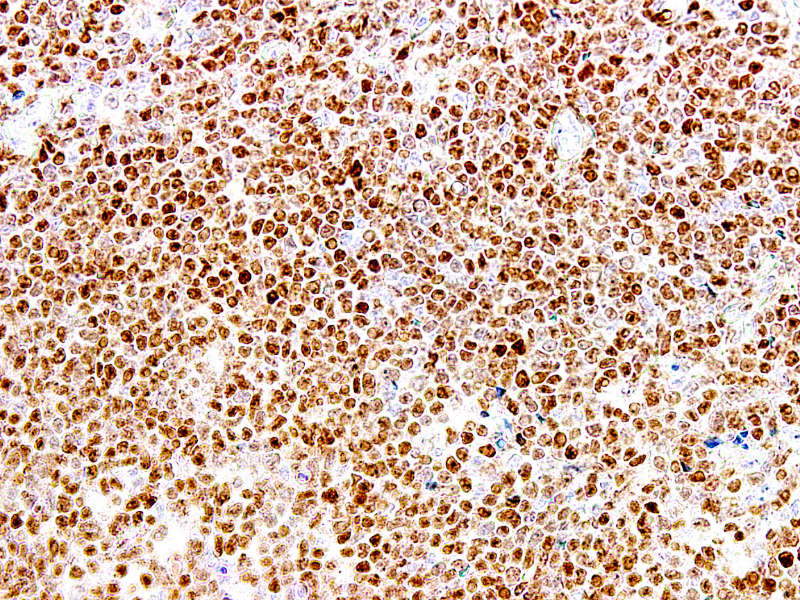 Mantle cell lymphoma cyclin D1