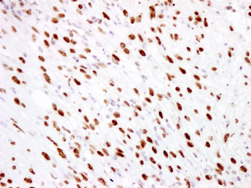 Pseudomyogenic hemangioendothelioma, FLI 1