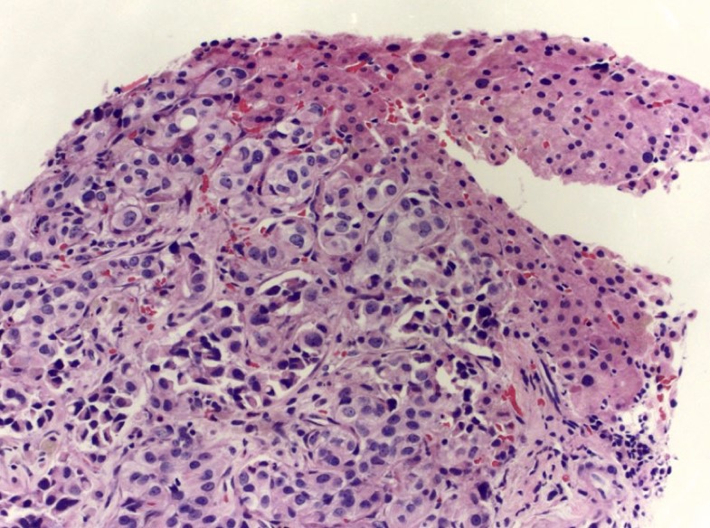 Metastatic breast carcinoma
