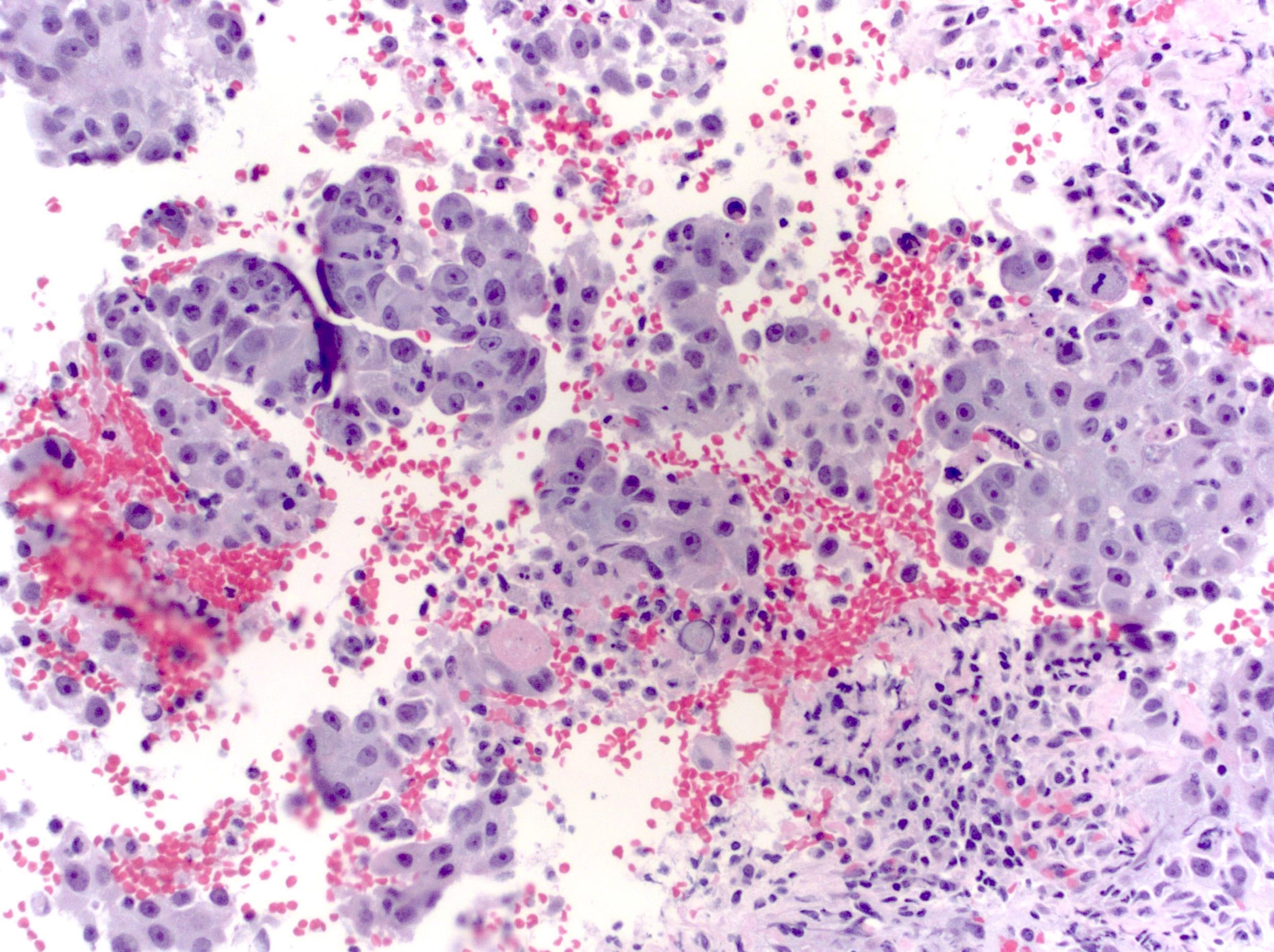 Poorly differentiated breast carcinoma