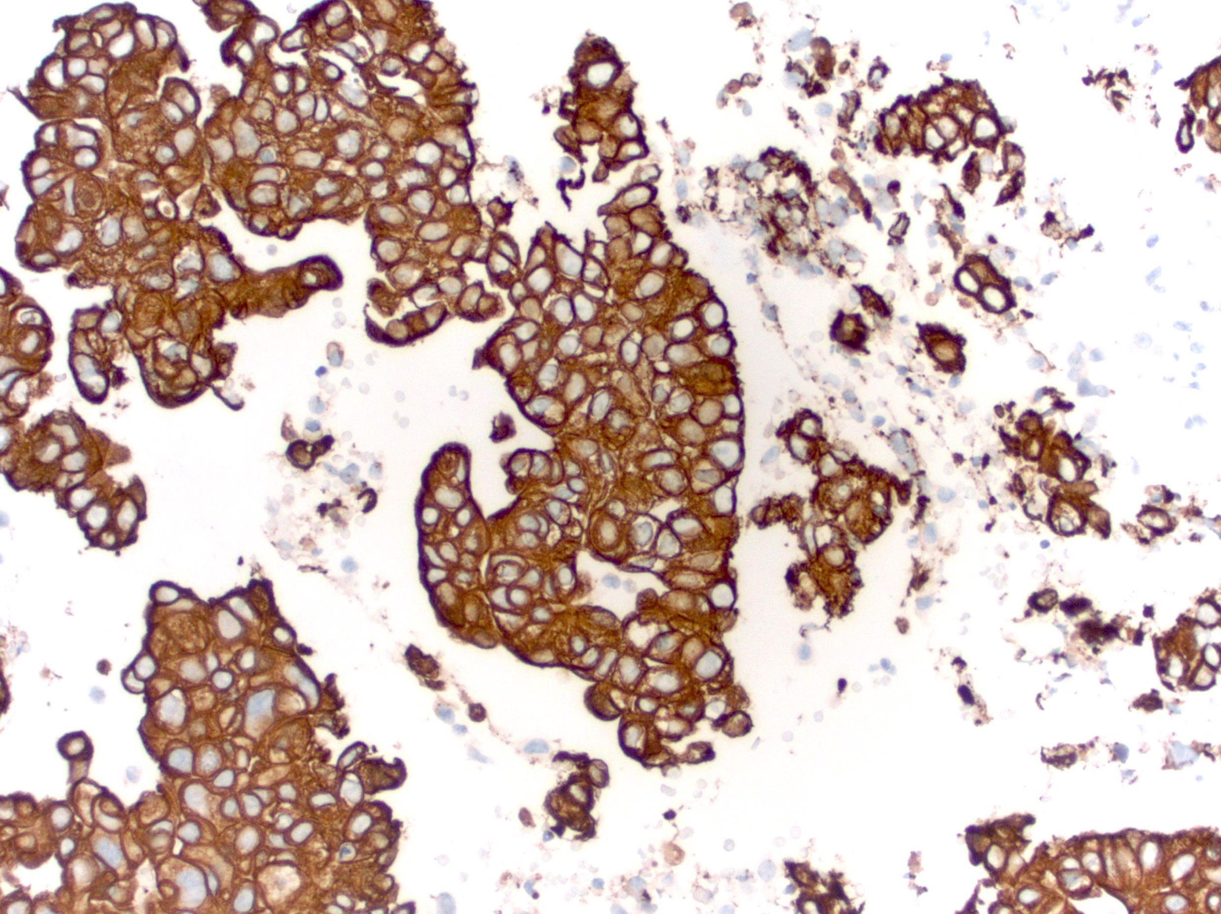 Poorly differentiated breast carcinoma