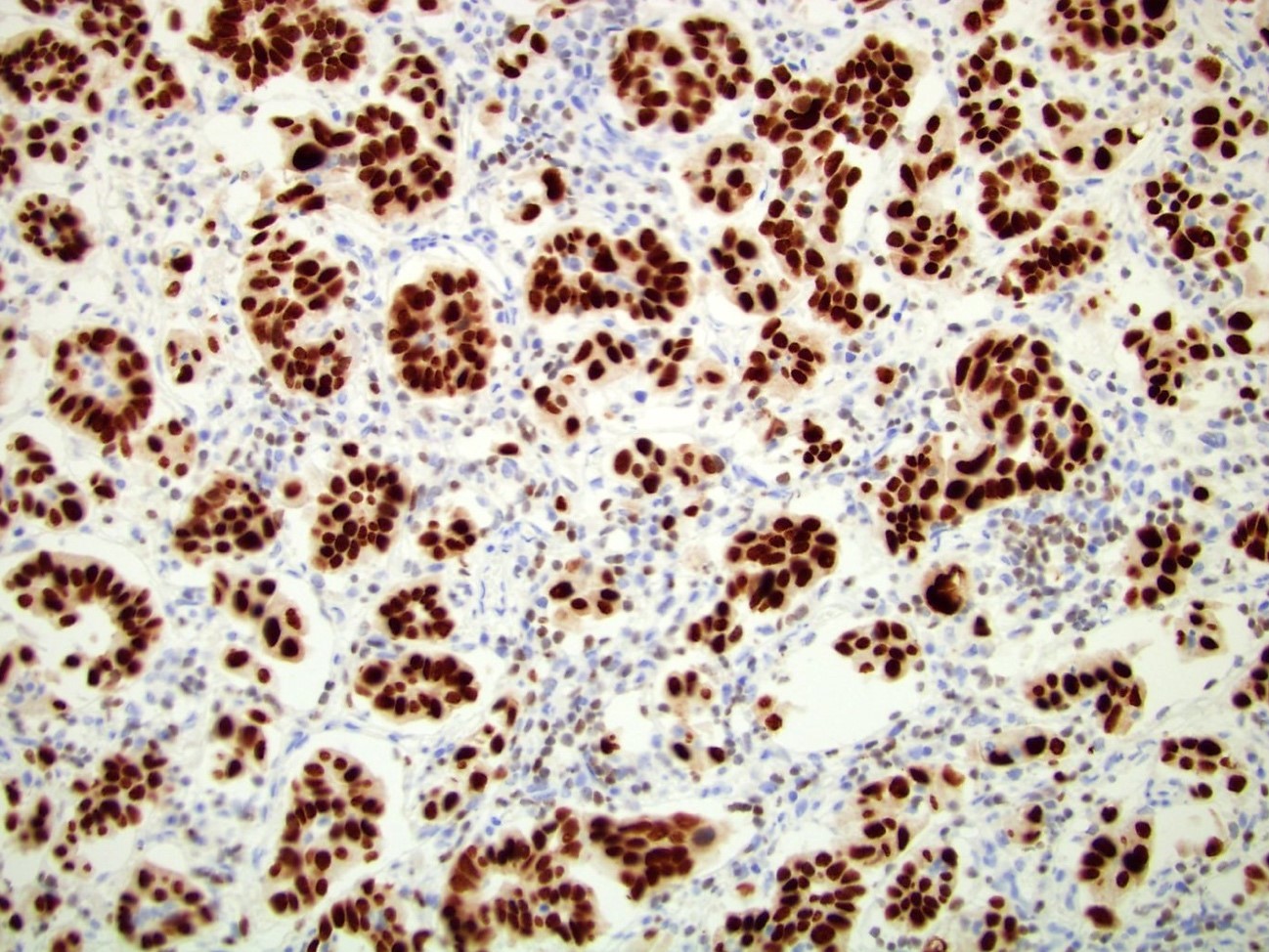 Invasive urothelial carcinoma