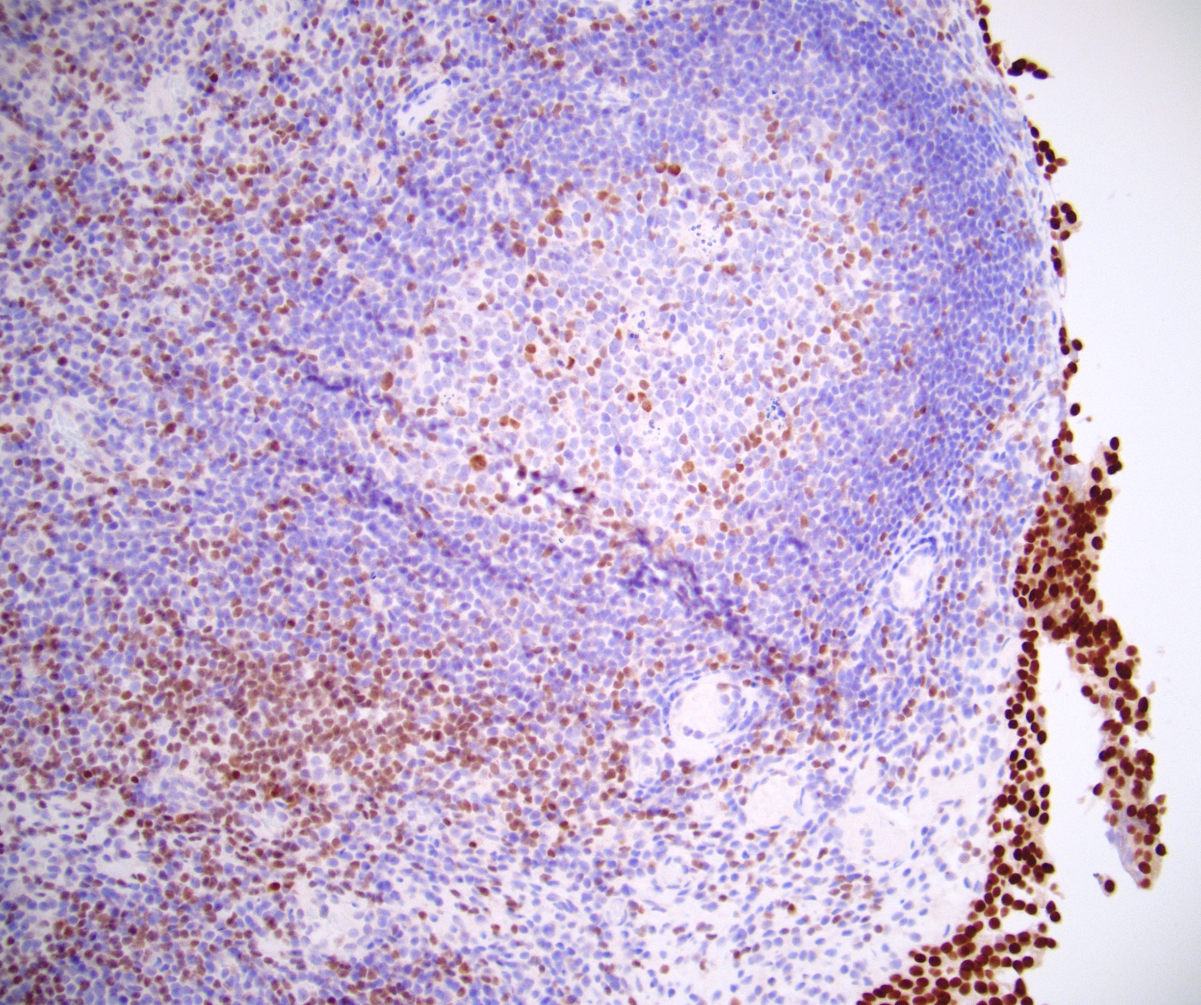 Nonneoplastic lymphocytes