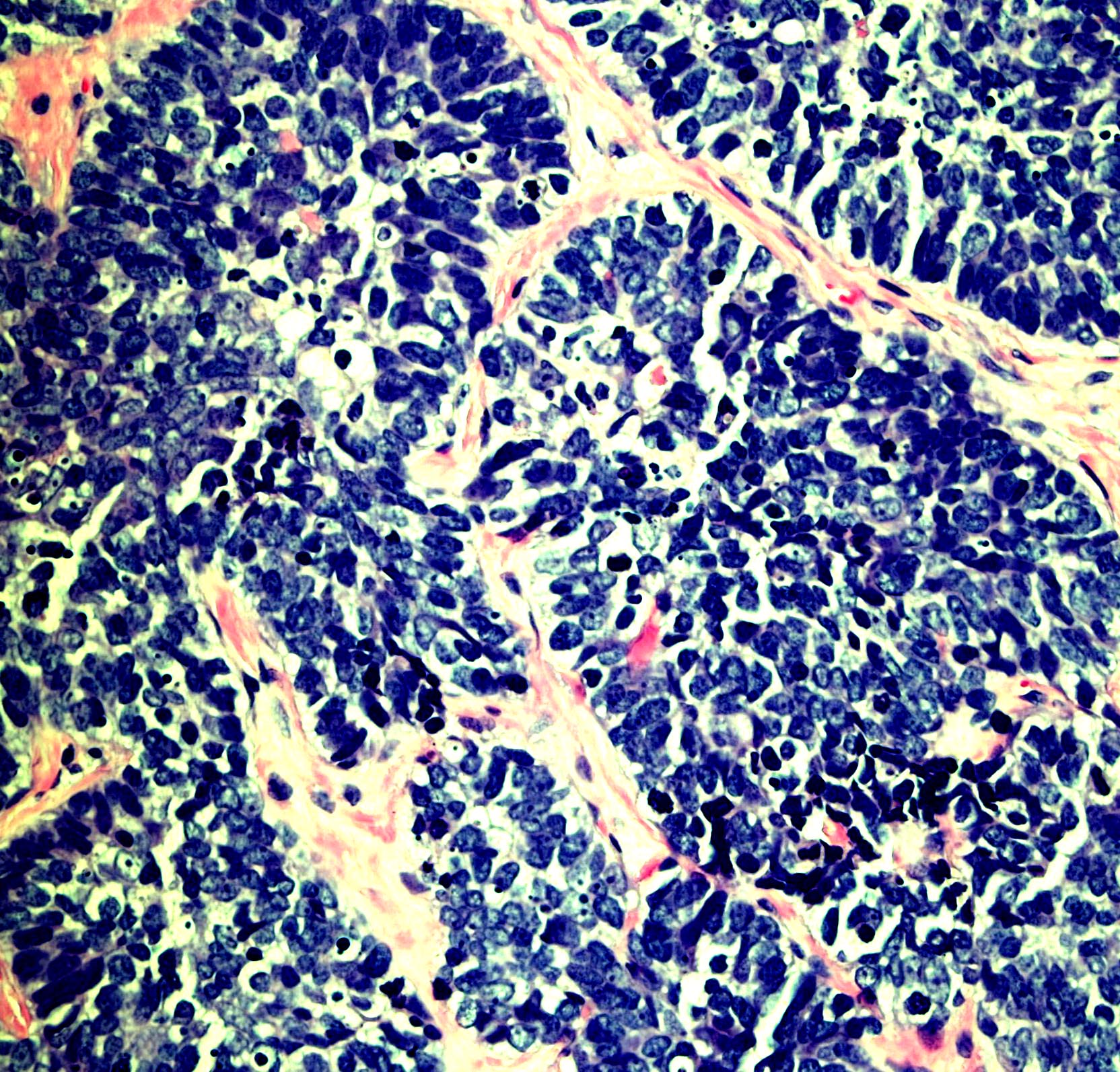 Lung small cell carcinoma