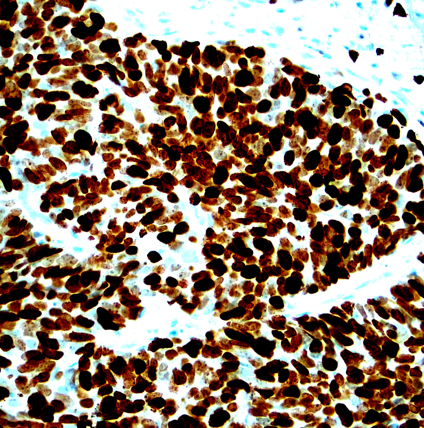 Lung small cell carcinoma