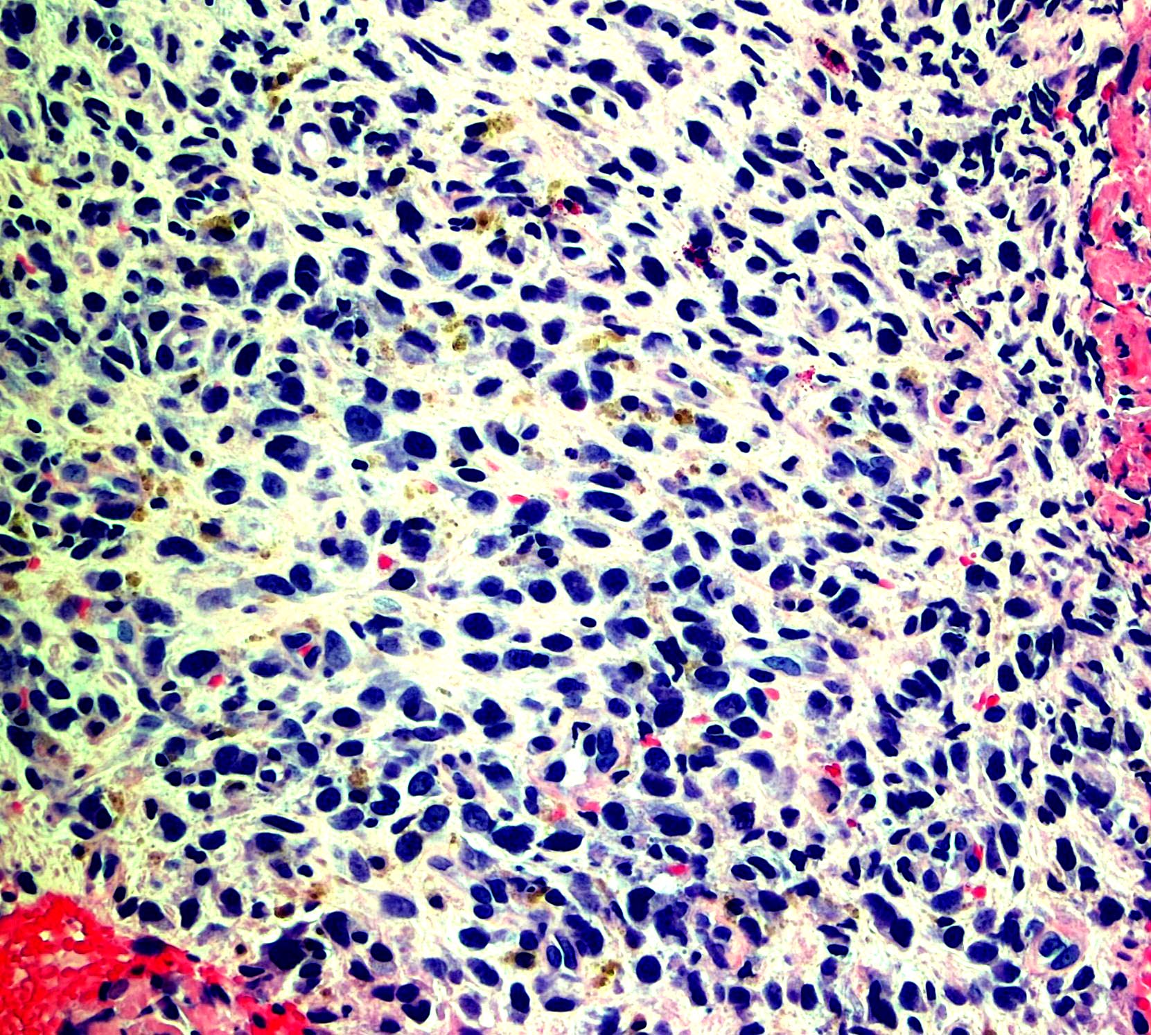 Brain diffuse large B cell lymphoma