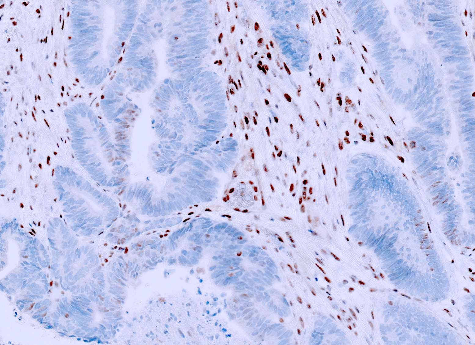 Pathology Outlines - Colon cancer biomarker testing (including MSI / Lynch)