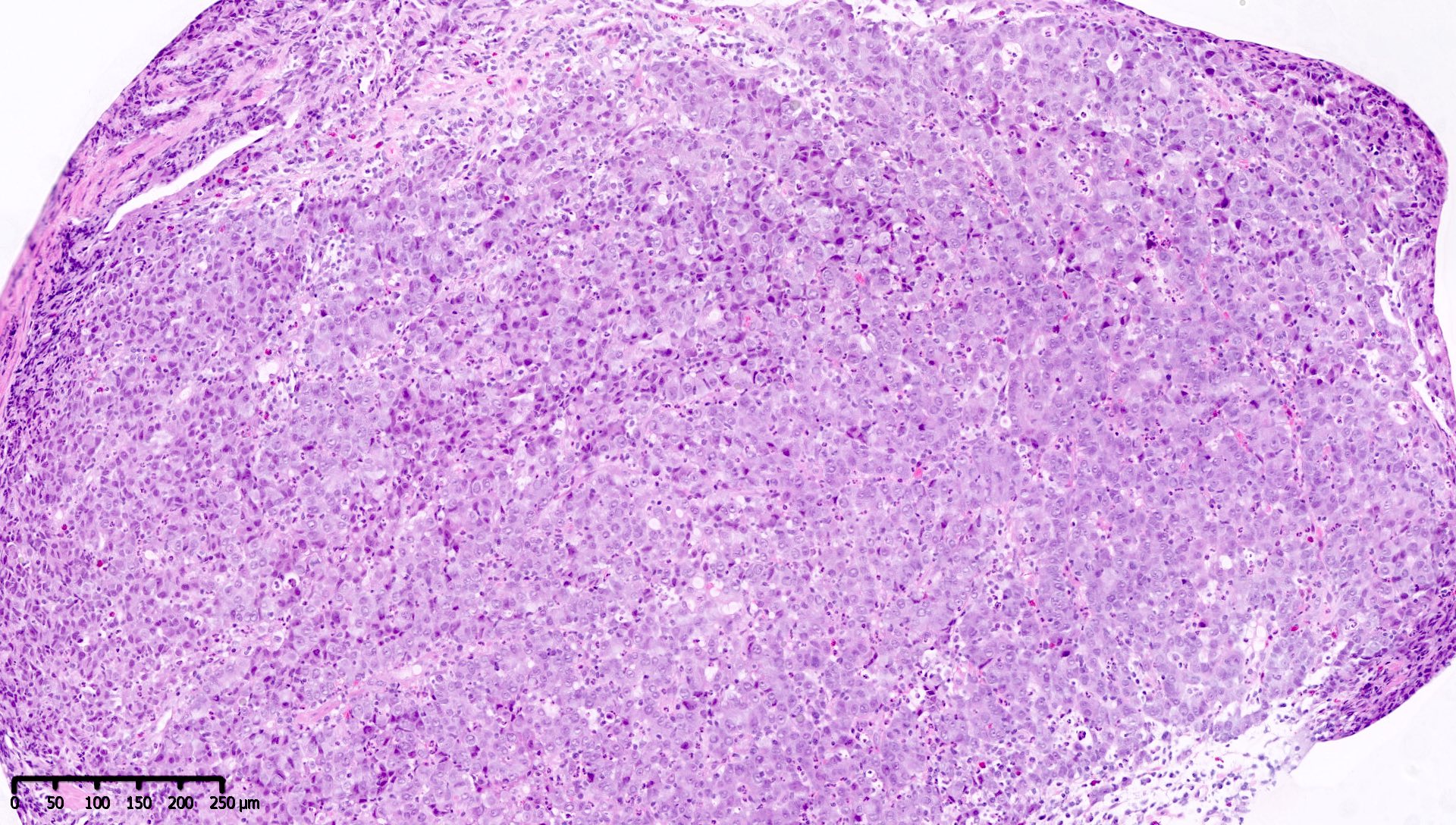 Moderately differentiated gastric adenocarcinoma