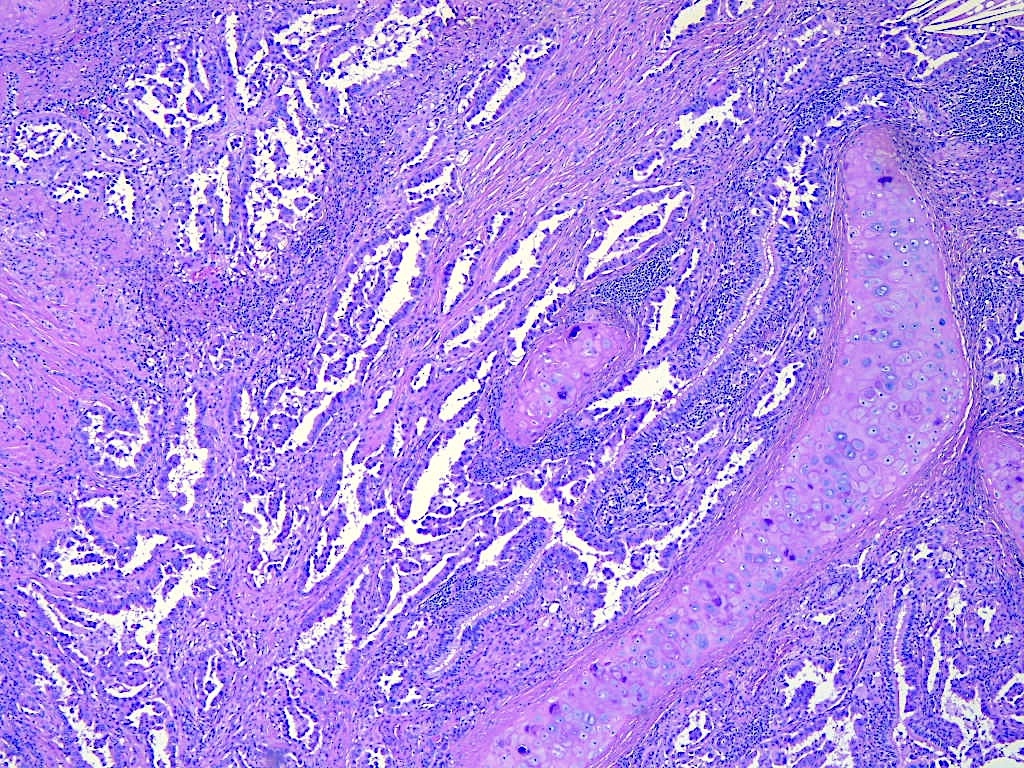 Lung resection, adenocarcinoma