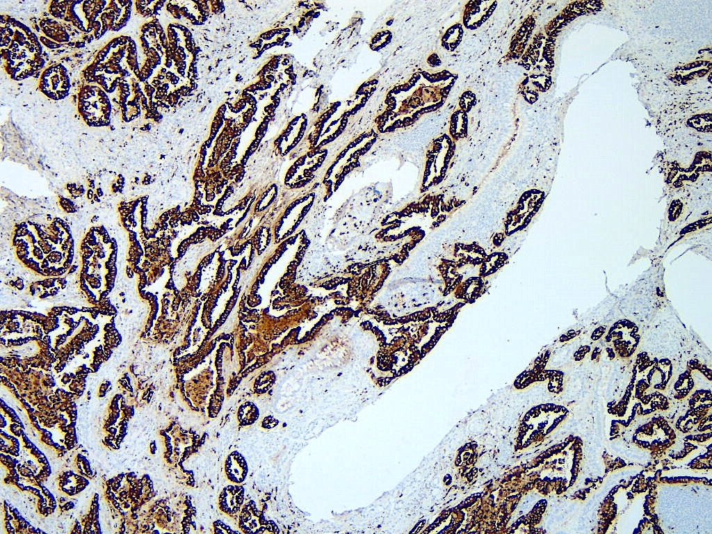 Lung resection, adenocarcinoma