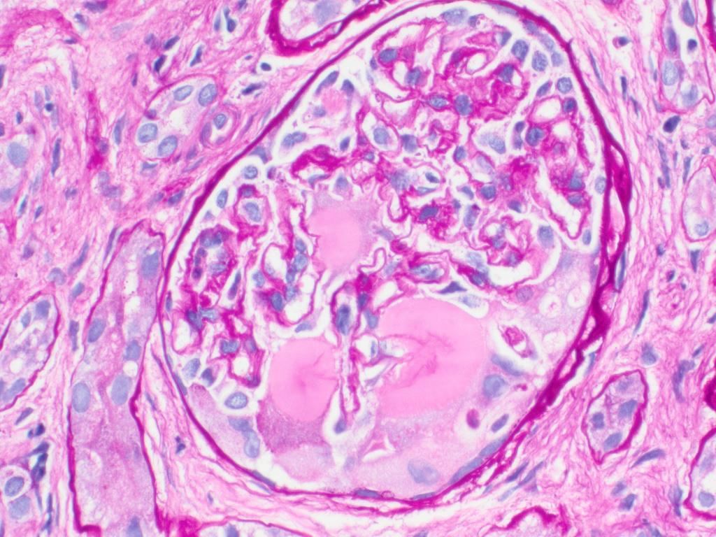 PAS negative amyloid in glomerulus