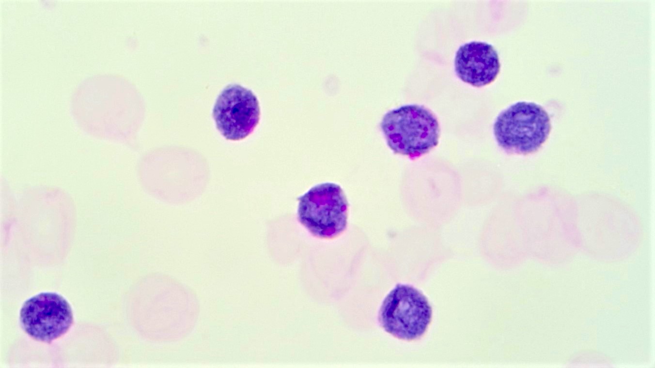 B lymphoblastic leukemia