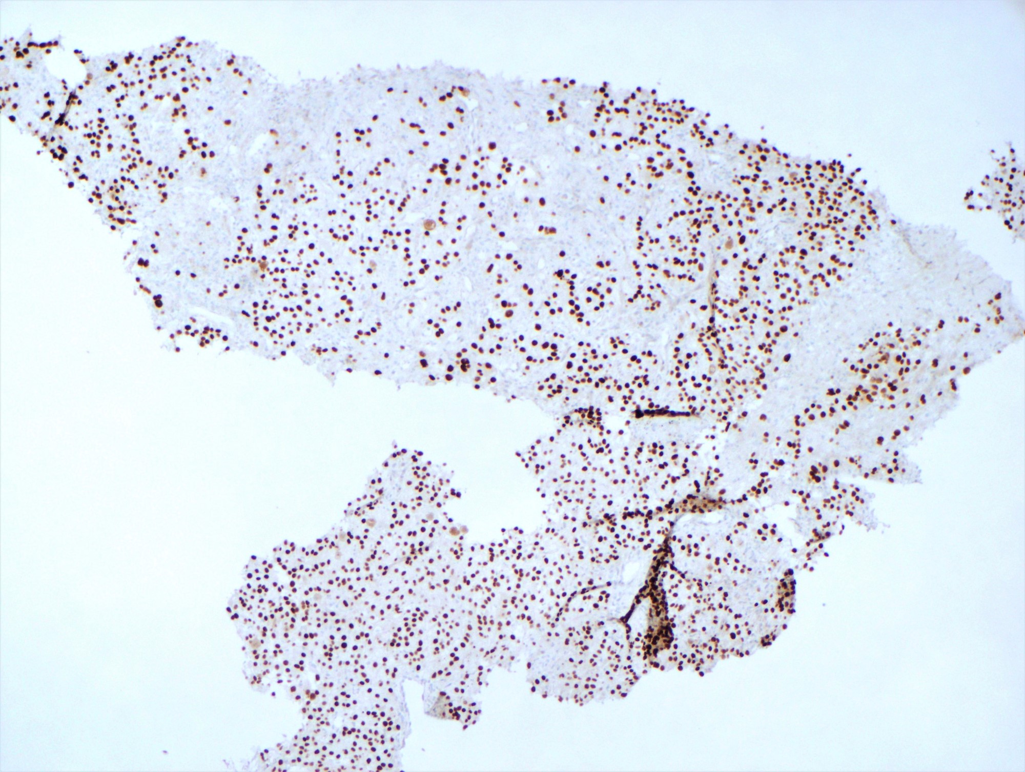 Metastatic renal cell carcinoma