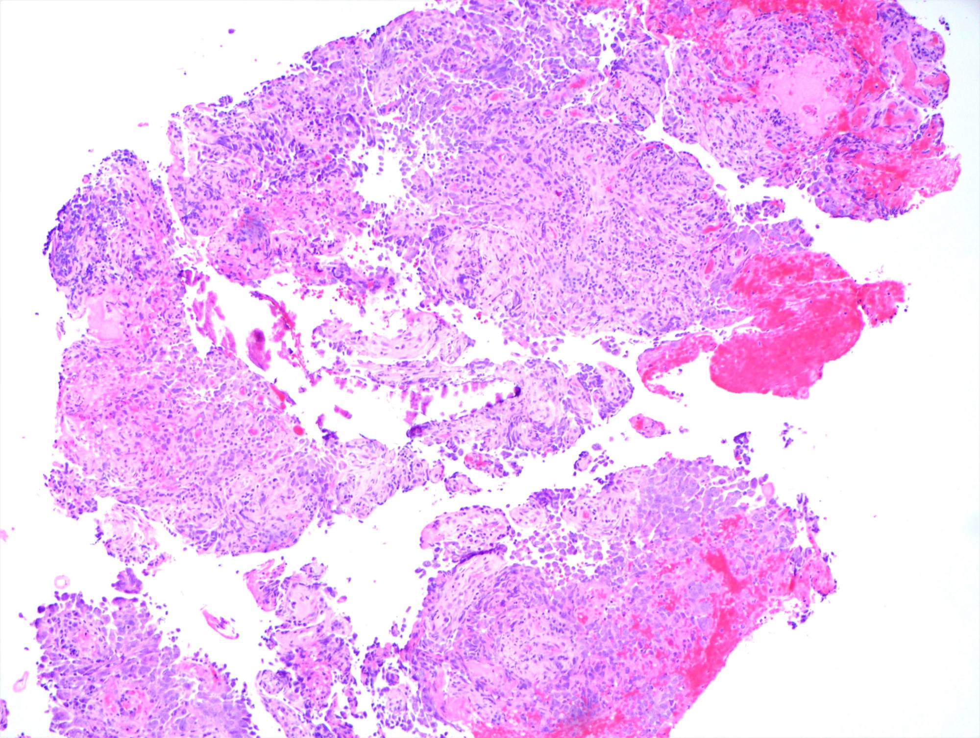 Metastatic ovarian serous carcinoma