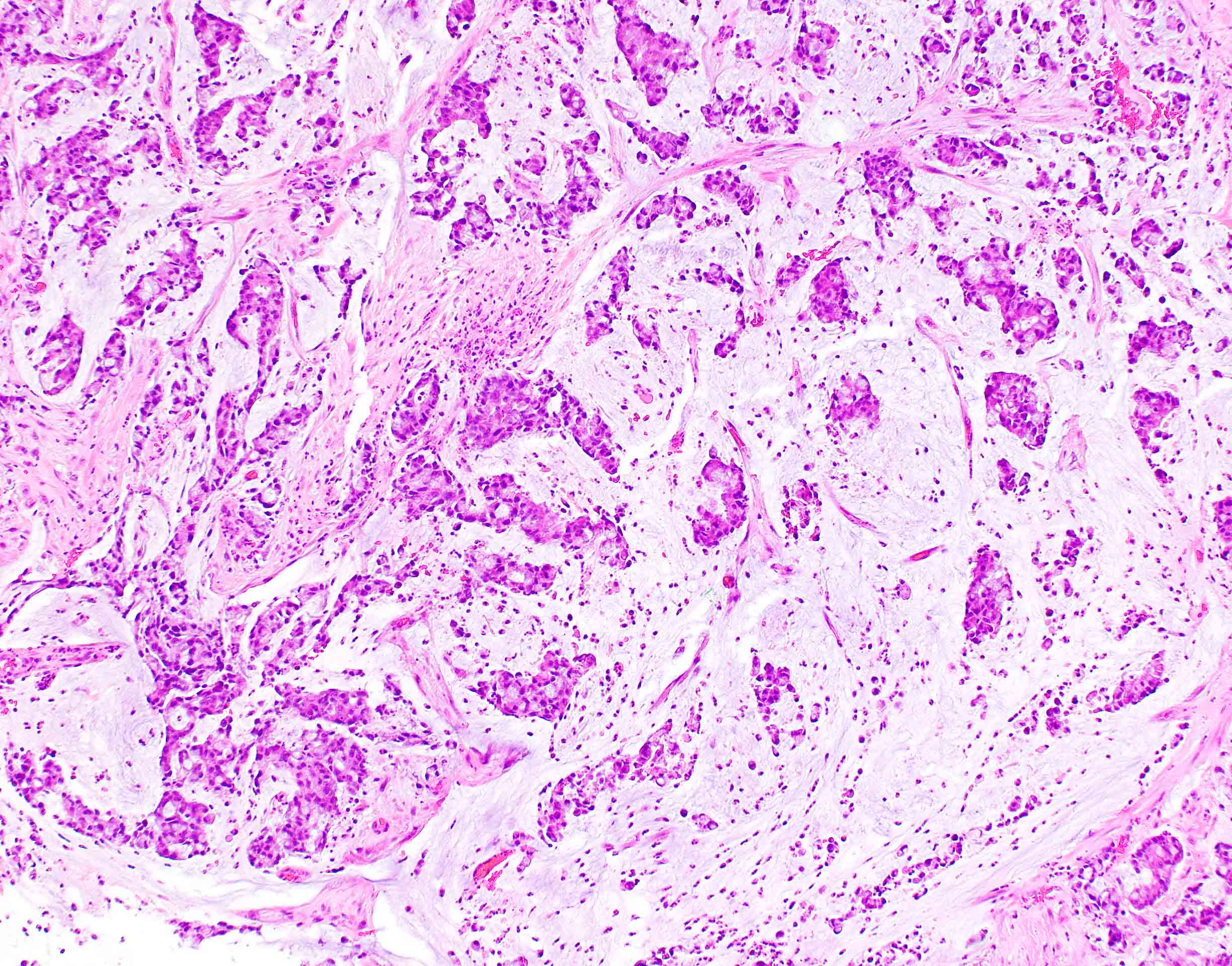 Mucinous adenocarcinoma of colon, moderately differentiated