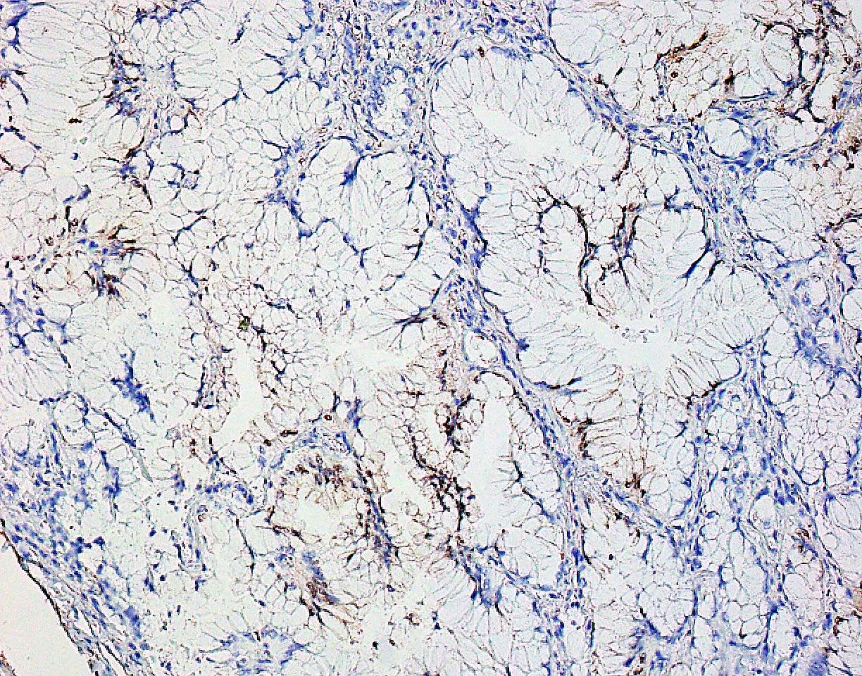 Rare case of SATB2+ mucinous lung adenocarcinoma