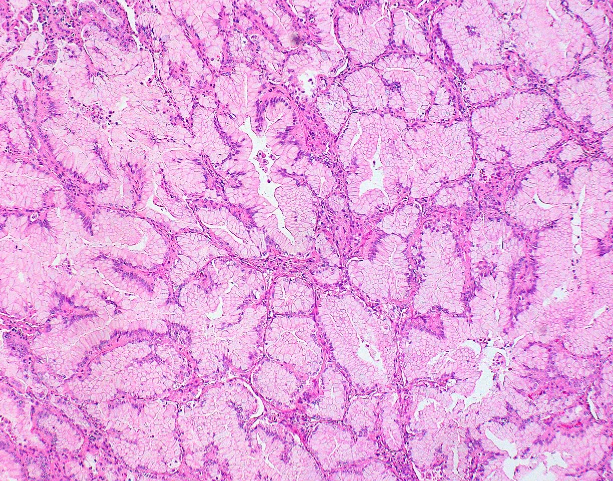 Rare case of SATB2+ mucinous lung adenocarcinoma