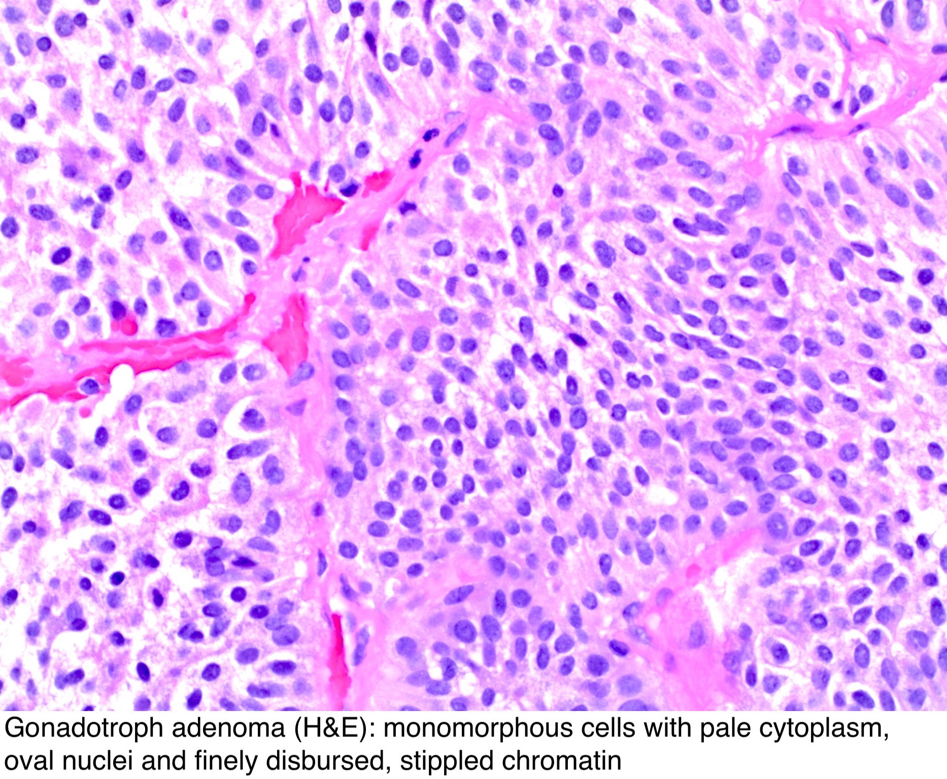 adenoma hypophysis pathology)