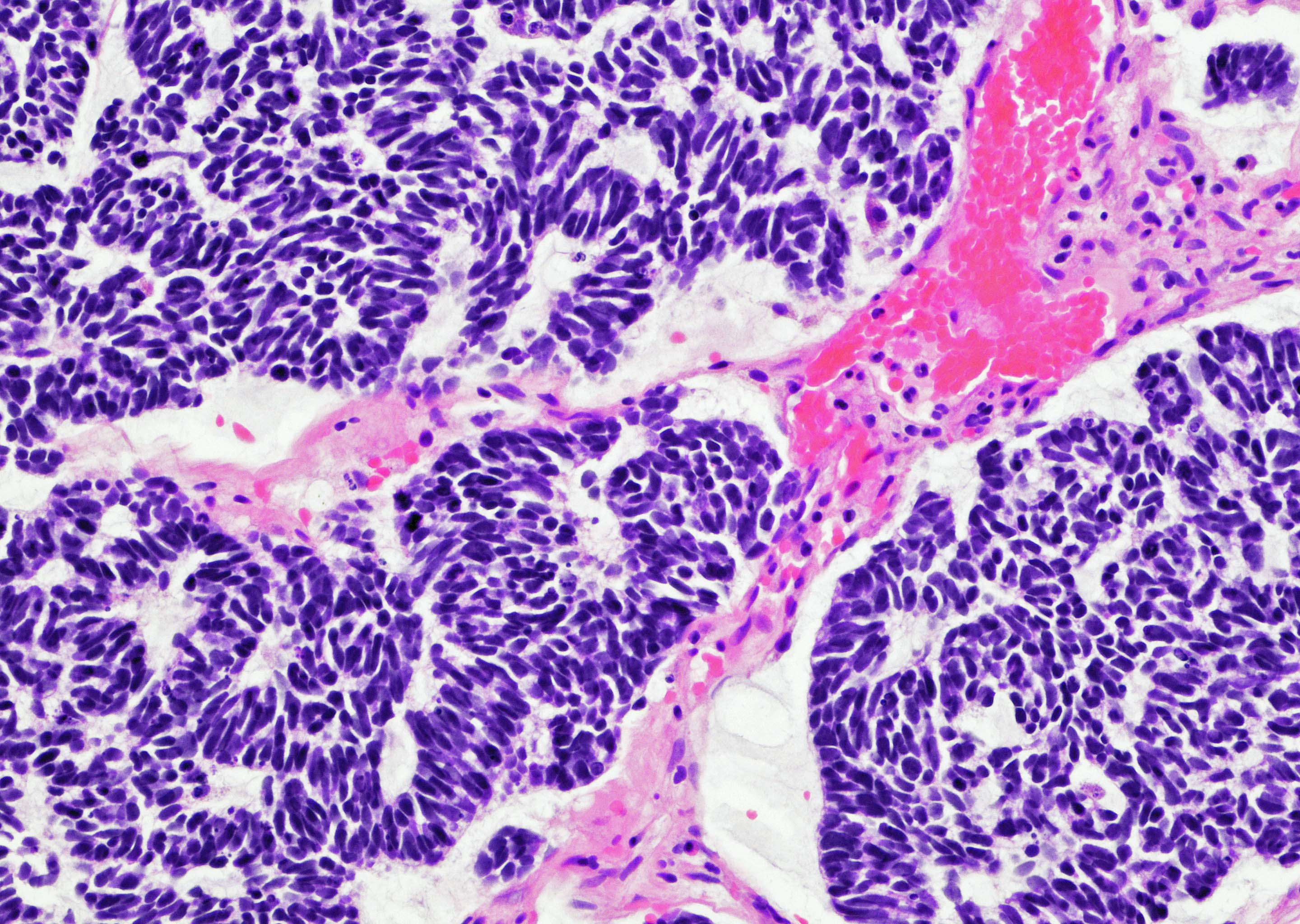 Bladder small cell neuroendocrine carcinoma