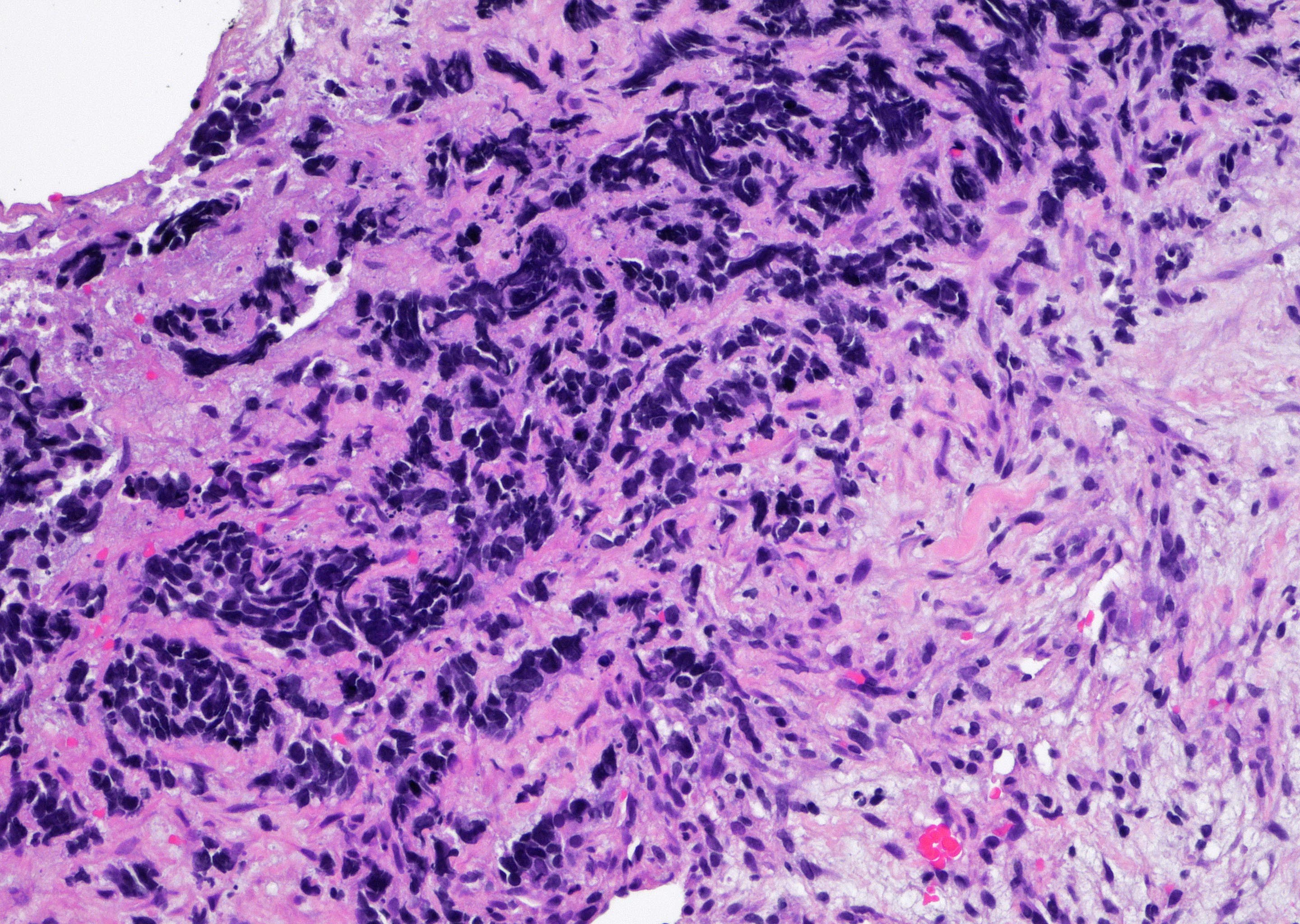 Liver small cell neuroendocrine carcinoma