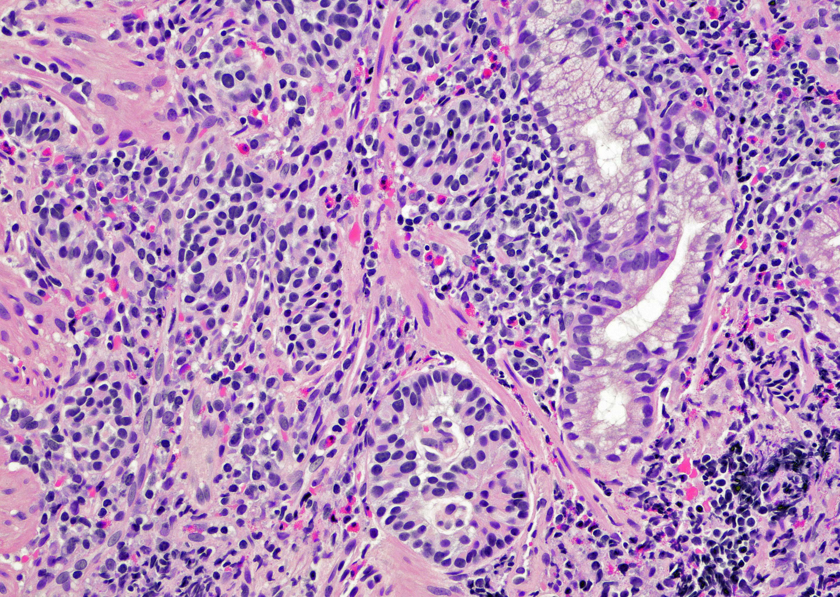 Duodenal well differentiated neuroendocrine tumor